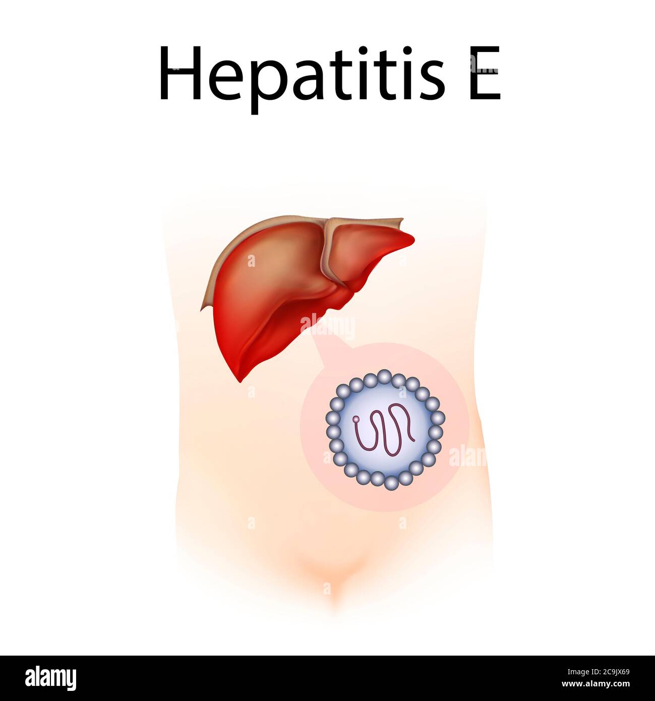 Epatite e, illustrazione. L'epatite è l'infiammazione del fegato. Foto Stock