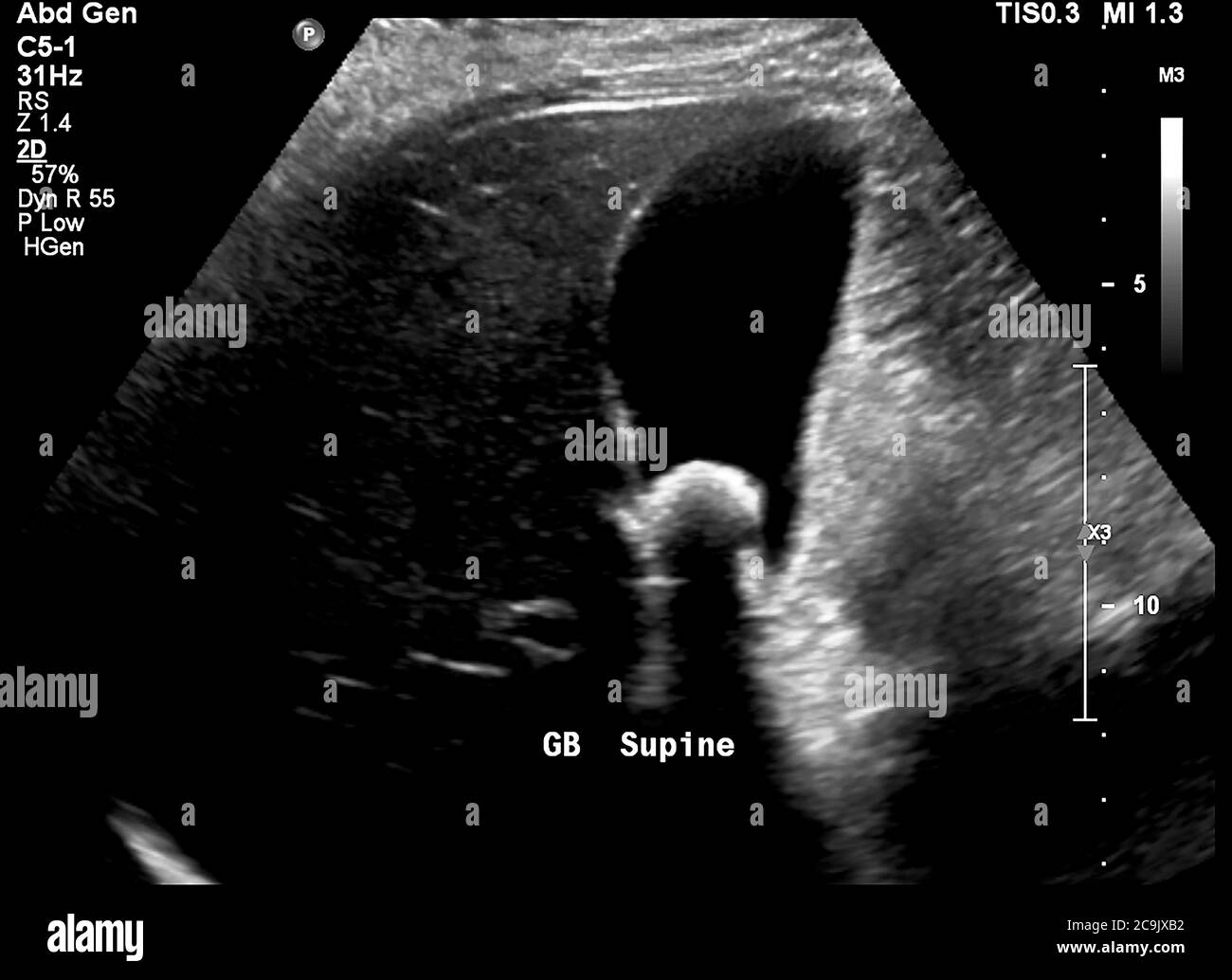 Gallstone. Ecografia della cistifellea di una donna di 33 anni, con un grosso gallone (15 millimetri di diametro) al centro. La cistifellea s Foto Stock