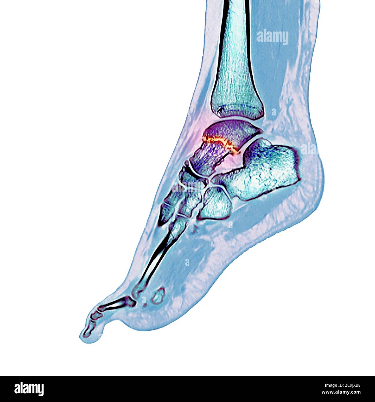 Osso della caviglia fratturato. Tomografia computerizzata a colori (CT) scansione delle ossa del piede e della caviglia di una donna di 23 anni con una sminuzzata (schizzata) Foto Stock