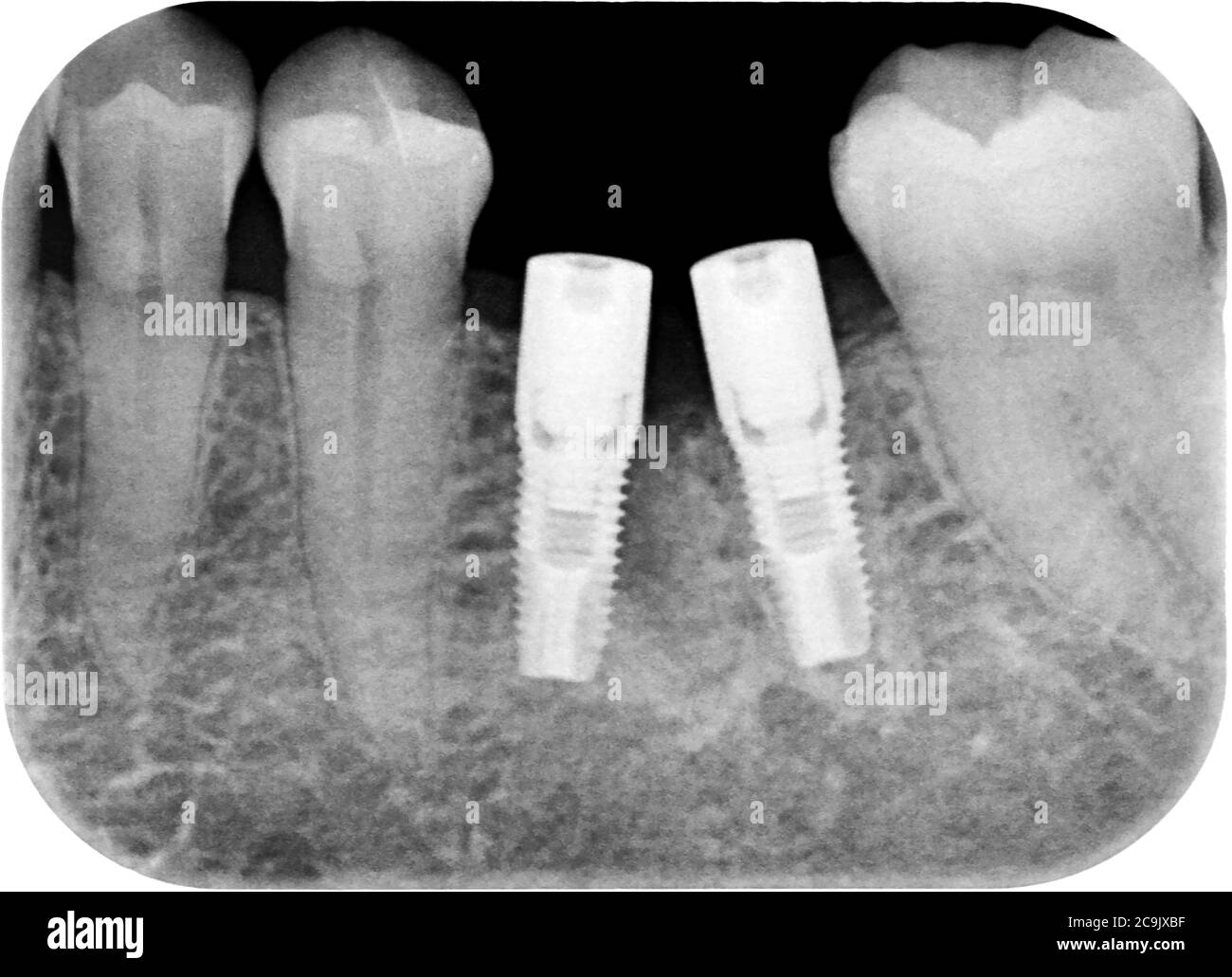 Impianti dentali a seguito dell'estrazione dei denti, raggi X. Durante questo intervento chirurgico, le postazioni dentali (bianche, centrali) vengono poste nell'osso della mandibola per consentire un urto dentale Foto Stock