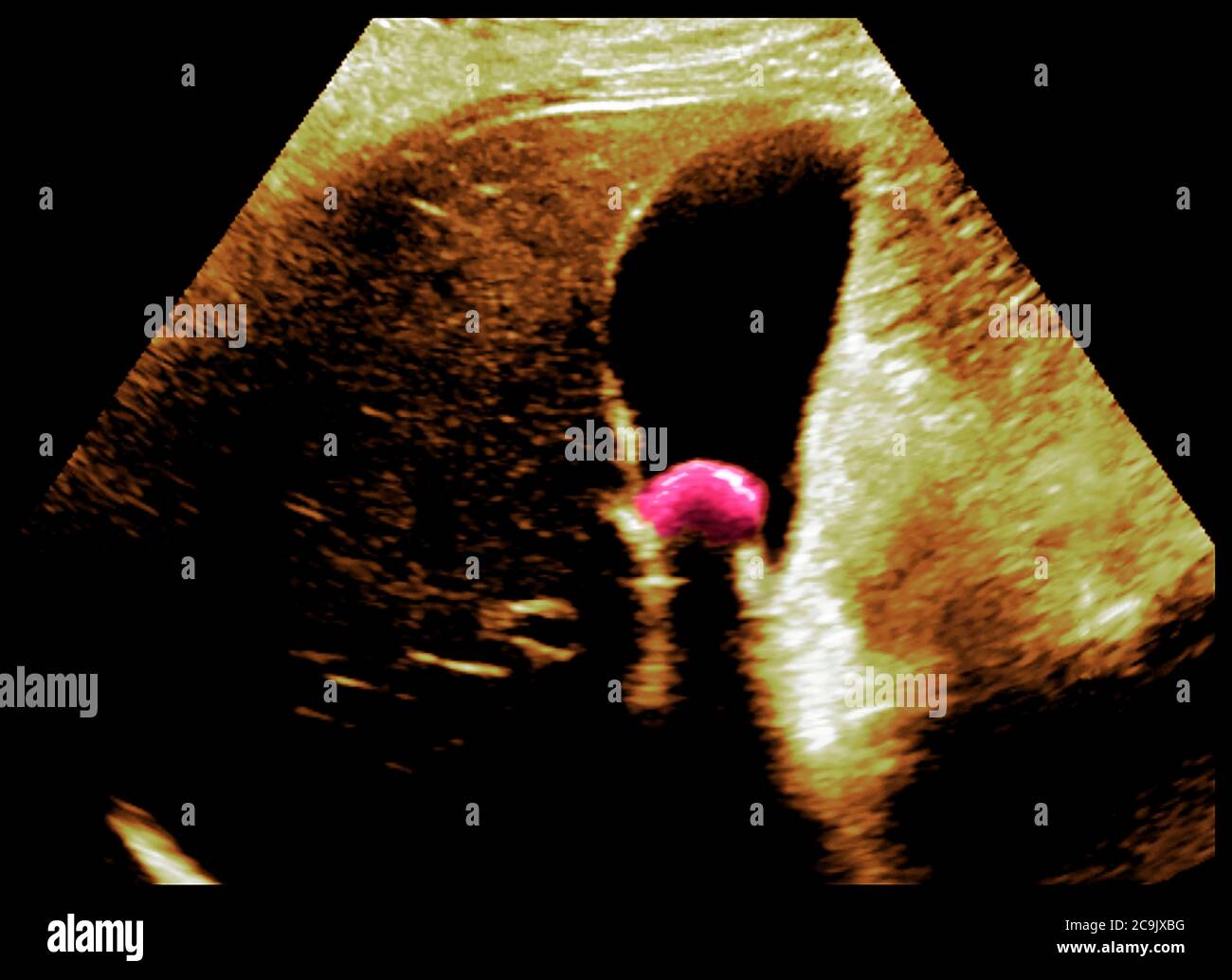 Gallstone. Ecografia colorata della cistifellea di una donna di 33 anni, con un grosso gallone (15 millimetri di diametro) al centro. Il gall Foto Stock
