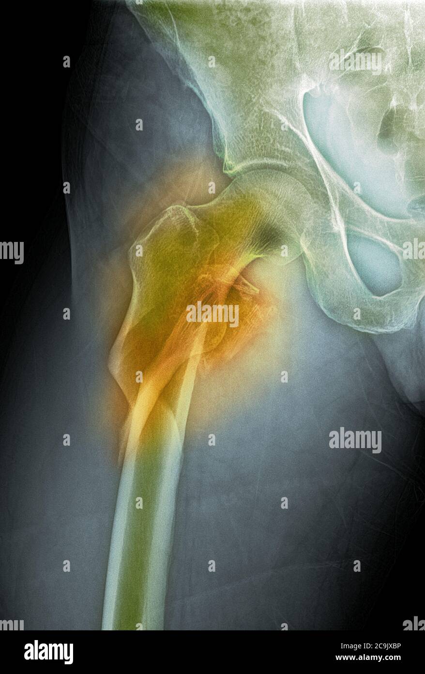 Frattura dell'anca. Radiografia frontale colorata dell'anca destra di un uomo di 53 anni, che mostra una frattura comminata (schizzata) del collo del femore (centr Foto Stock