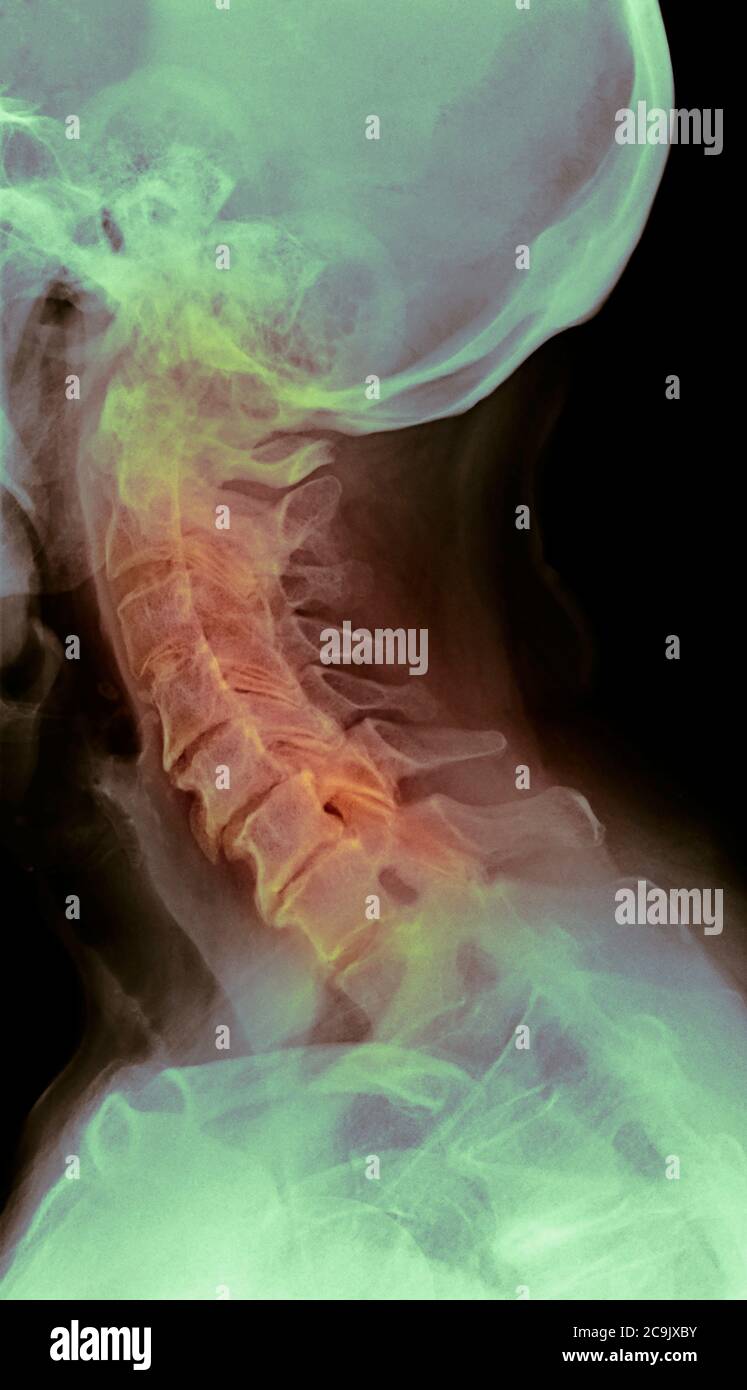Osteoartrite della colonna cervicale. Radiografia laterale colorata del collo di una donna di 76 anni con osteoartrite grave della colonna cervicale. Oste Foto Stock