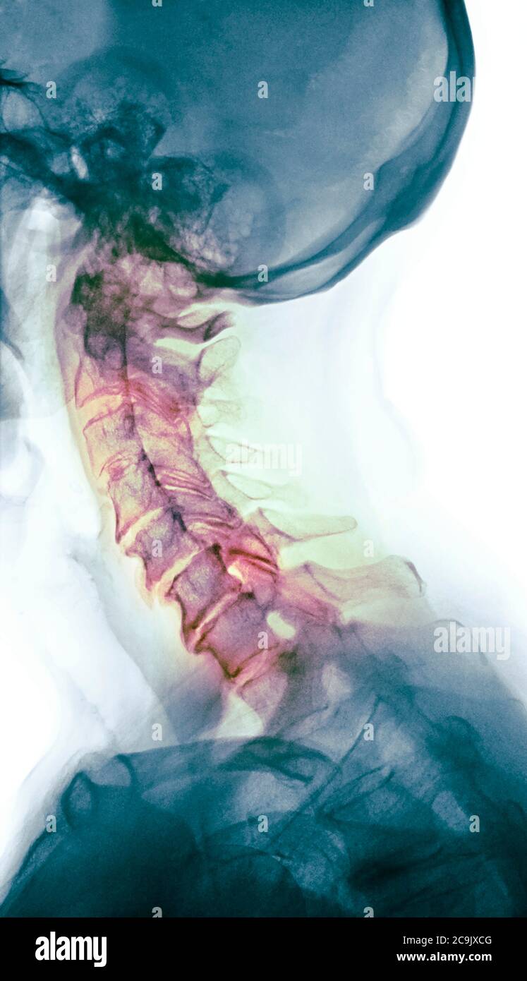 Osteoartrite della colonna cervicale. Radiografia laterale colorata del collo di una donna di 76 anni con osteoartrite grave della colonna cervicale. Oste Foto Stock