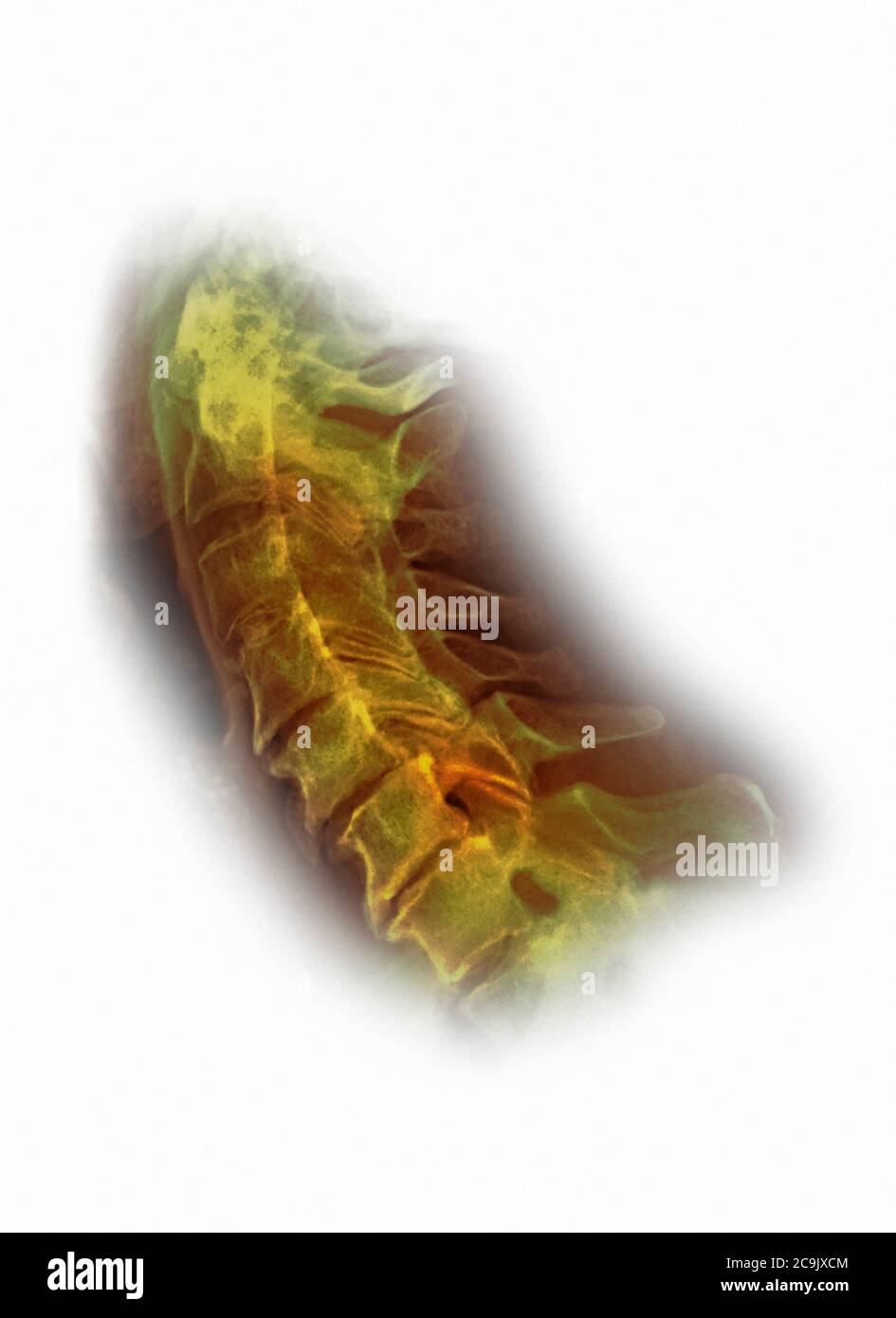 Osteoartrite della colonna cervicale. Radiografia laterale colorata del collo di una donna di 76 anni con osteoartrite grave della colonna cervicale. Oste Foto Stock