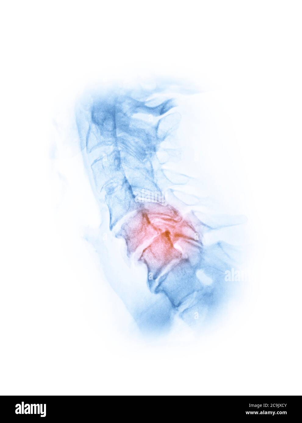 Osteoartrite della colonna cervicale. Radiografia laterale colorata del collo di una donna di 76 anni con osteoartrite grave della colonna cervicale. Oste Foto Stock