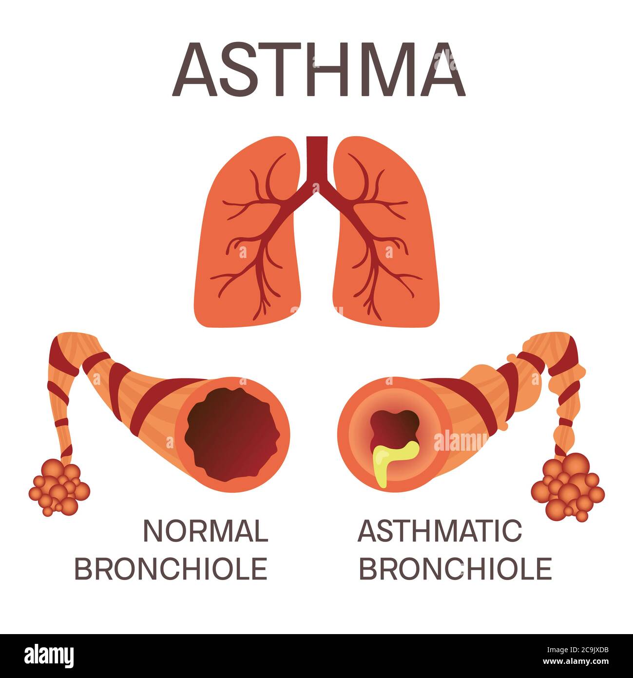 Bronchioli normali e asmatici, illustrazione. Foto Stock