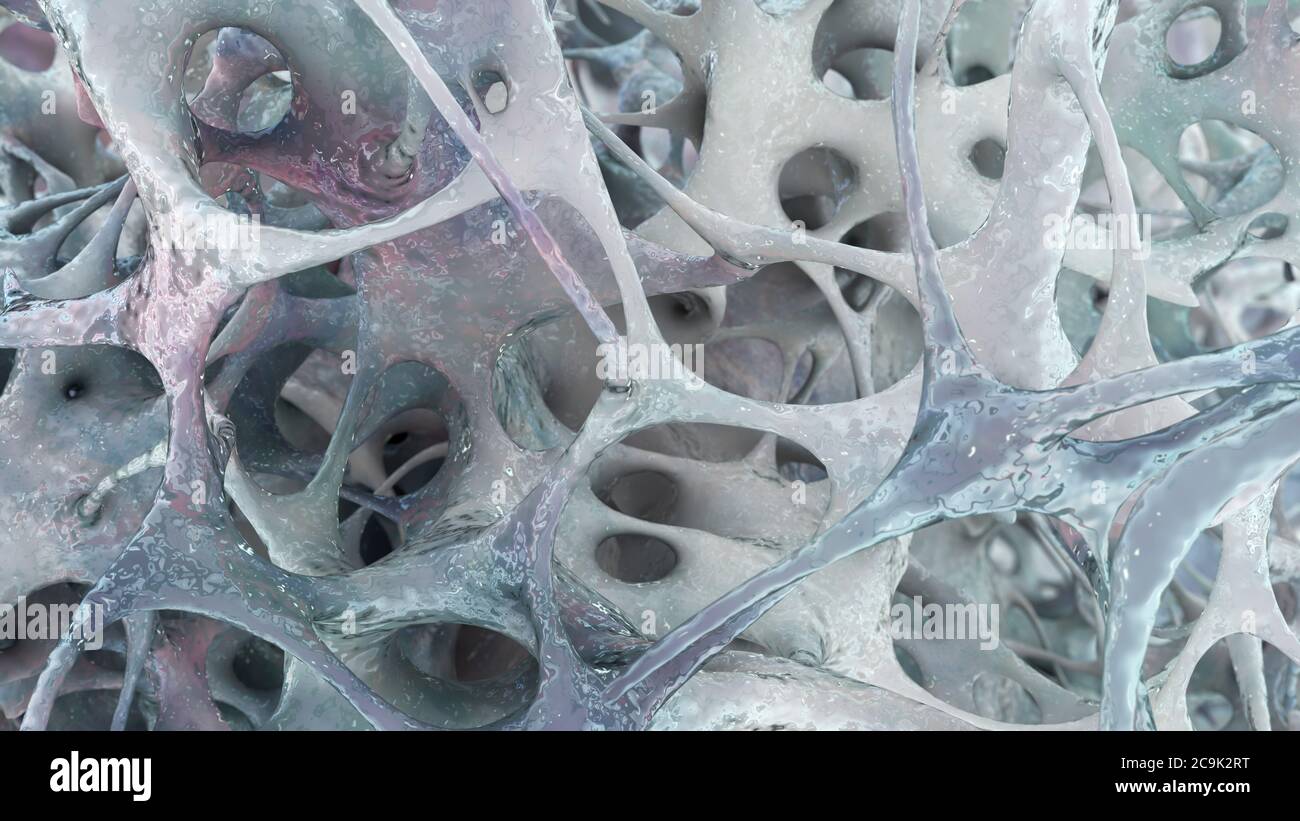 Illustrazione della struttura ossea colpite da osteoporosi. Assottigliamento della matrice ossea è visibile. Foto Stock