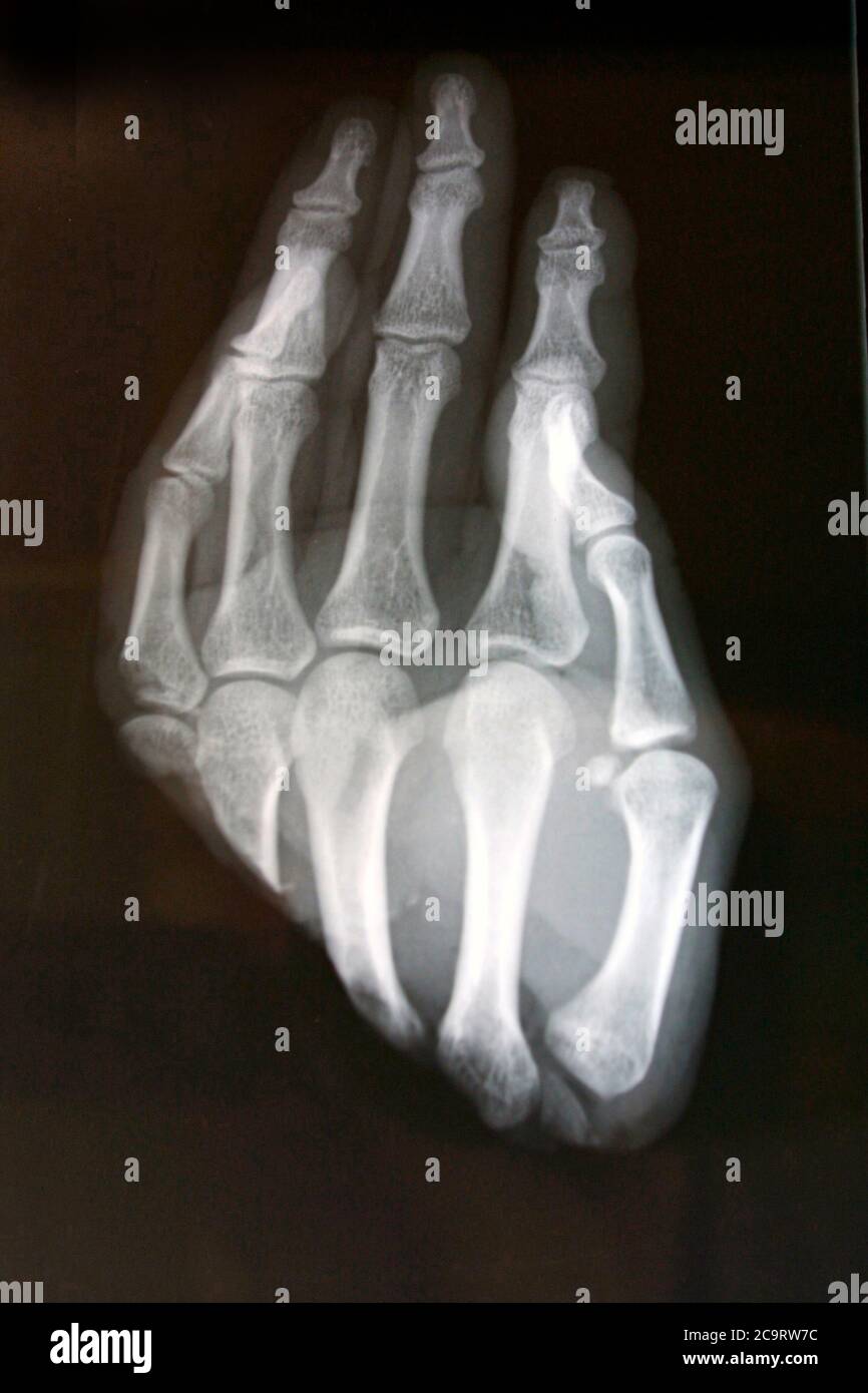 immagine radiografica di una mano umana con cinque dita Foto Stock