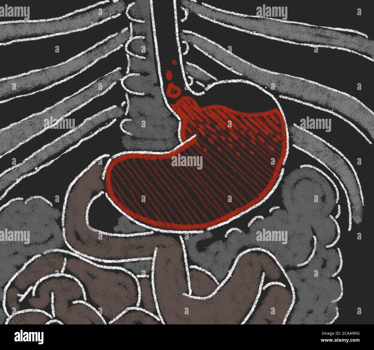 Riflusso acido, GERD. Malattia da reflusso gastroesofageo. Stomaco e digestivo. Anatomia umana. illustrazione 3d Foto Stock