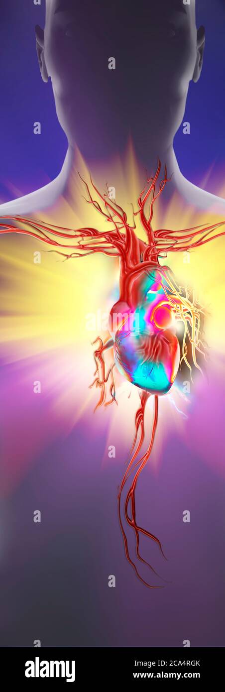 Rappresentazione illustrativa dell'attacco cardiaco Foto Stock
