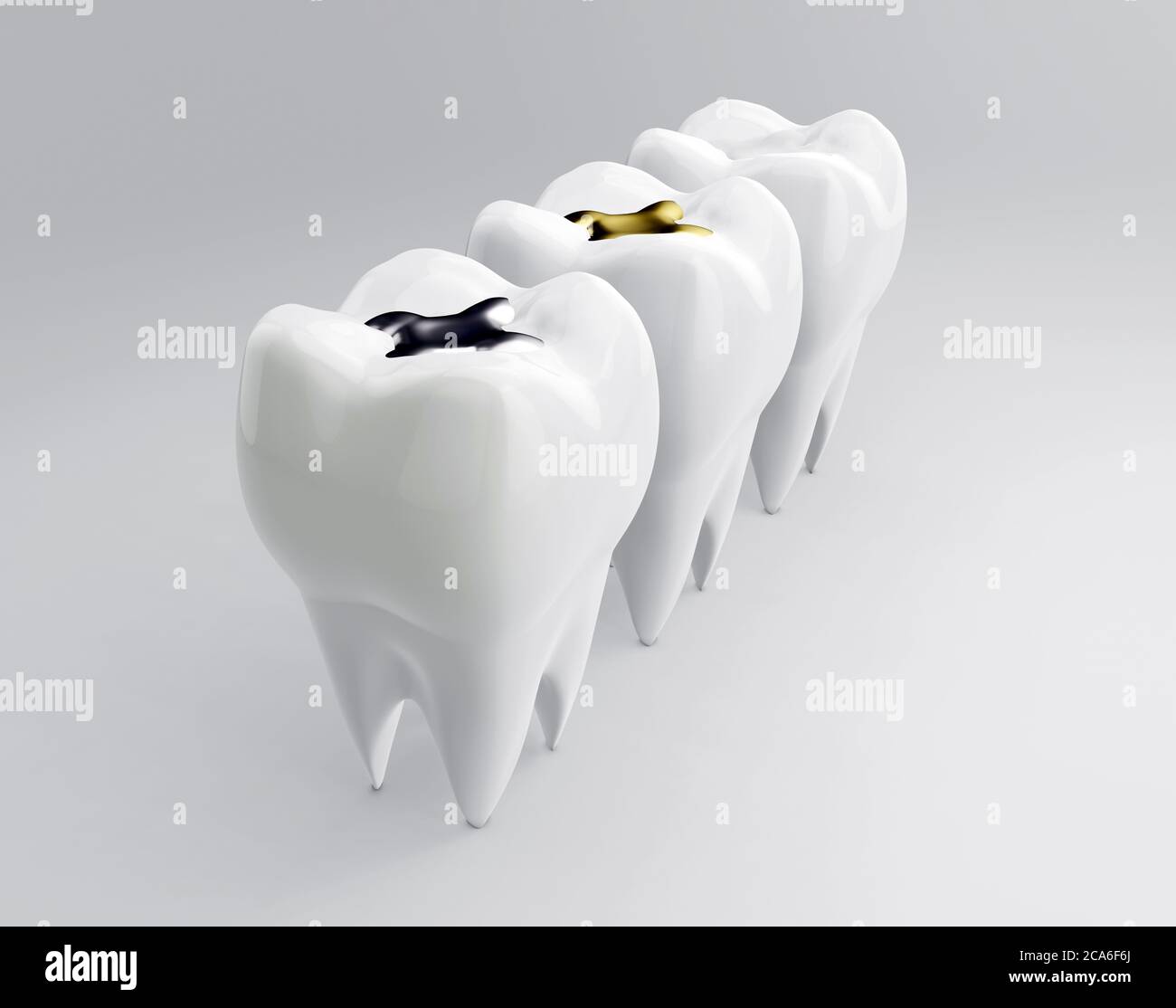 Denti con riempimento dentale in oro, amalgama e inserti compositi. Molari su sfondo bianco. Diversi tipi di riempimento, rendering 3d Foto Stock