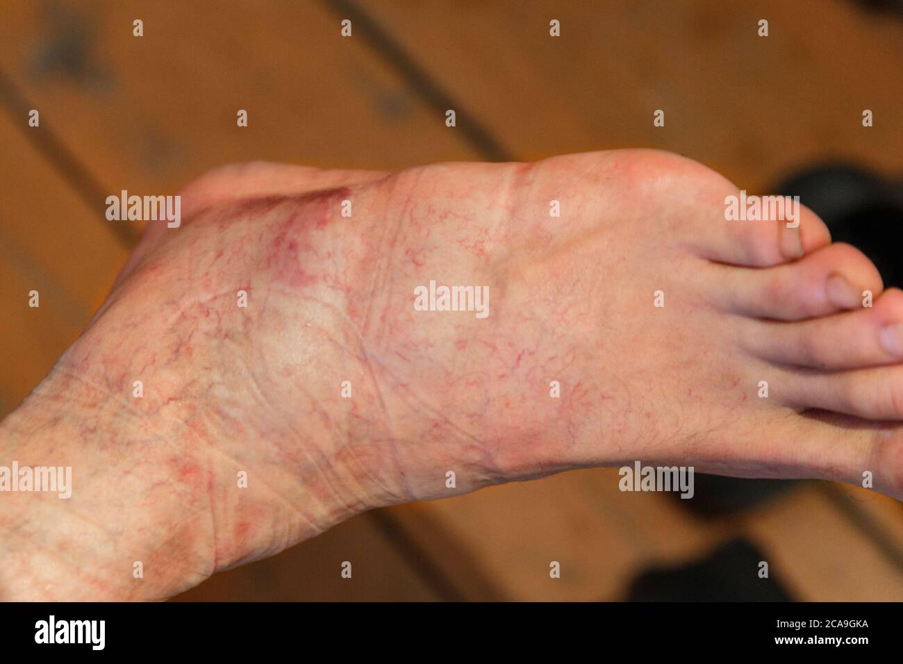 Gonfiore, lesioni del piede maschio con vene capillari multiple. Foto Stock