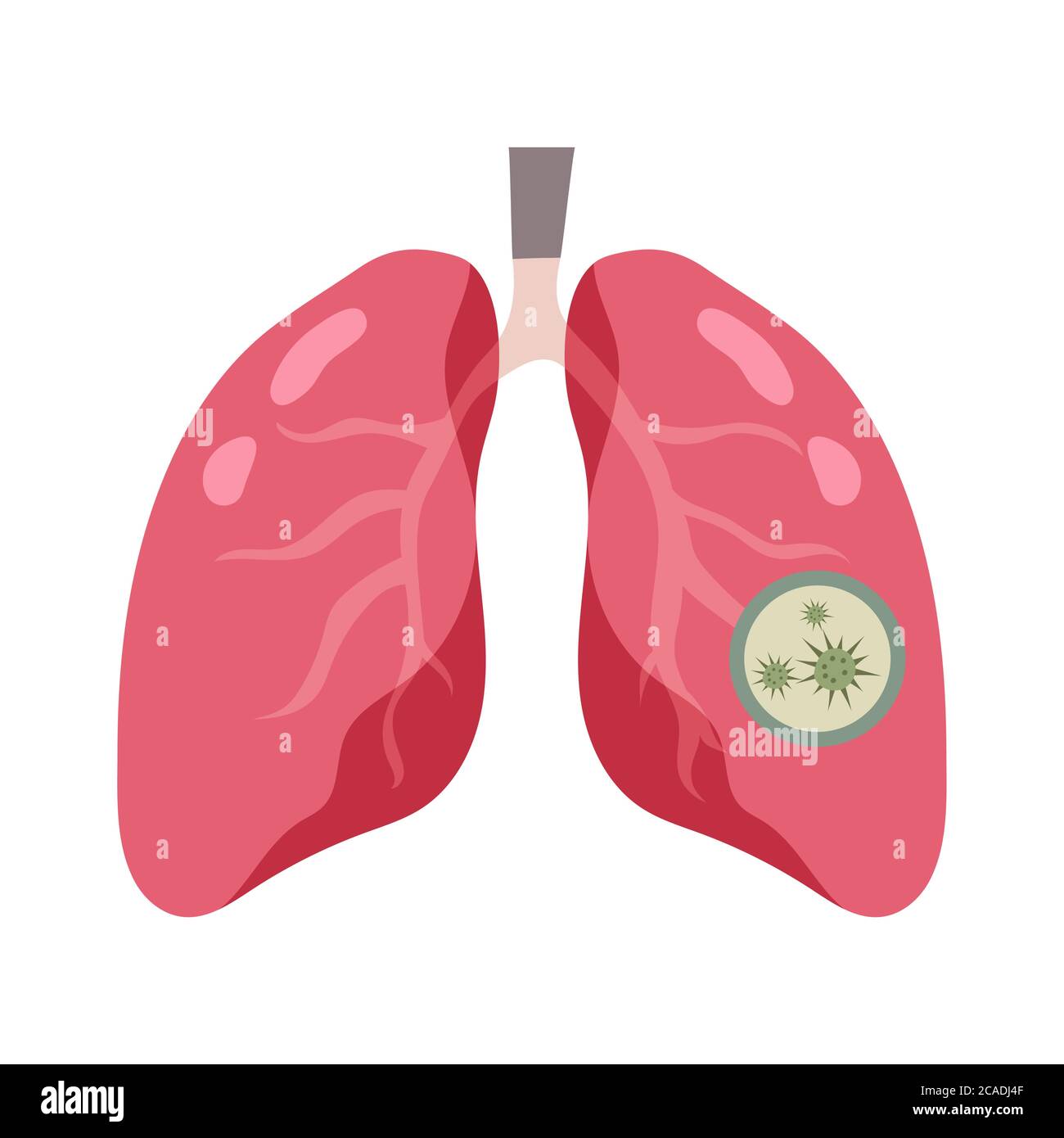Polmoni sani e malattia polmoni vettore Illustrazione Illustrazione Vettoriale