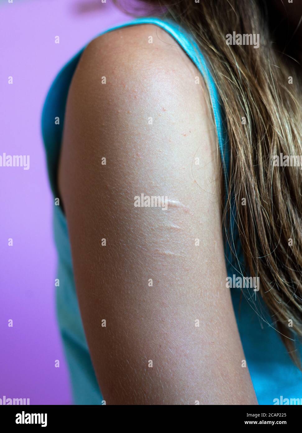 Braccio di giovani donne che mostra le cicatrici da auto mutilazione, su sfondo semplice auto danno . stanza per il testo. Foto Stock