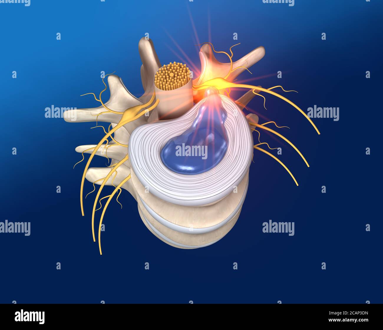 illustrazione che mostra vertebra lombale con disco intervertebrale e nucleo gerniato polposo Foto Stock