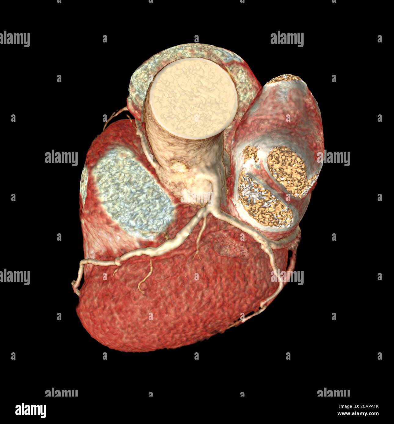 Vista dall'alto dell'arteria coronaria CTA immagine 3D di rendering isolata o backgroud nero per l'individuazione di coronaropatia.percorso dei clipsuini. Foto Stock