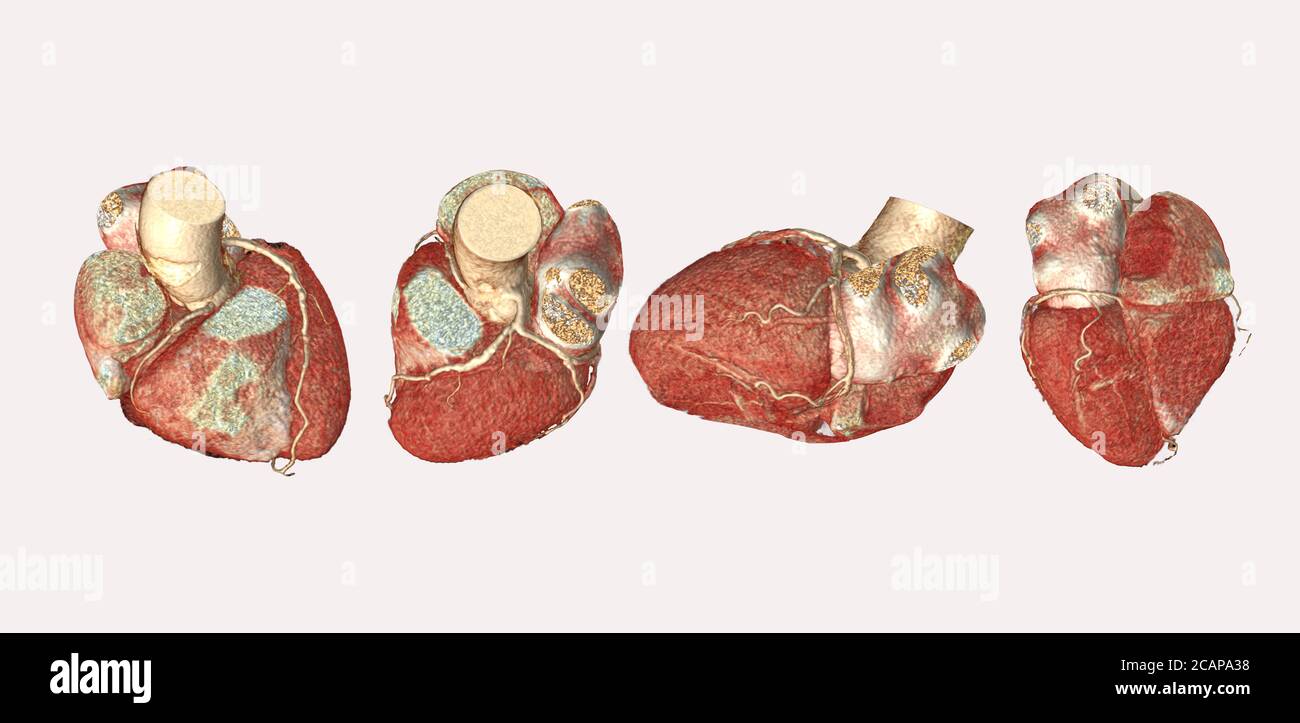 Raccolta dell'arteria coronaria CTA immagine 3D di rendering isolata o backgroud bianco per l'individuazione della malattia coronarica.percorso dei clippini. Foto Stock