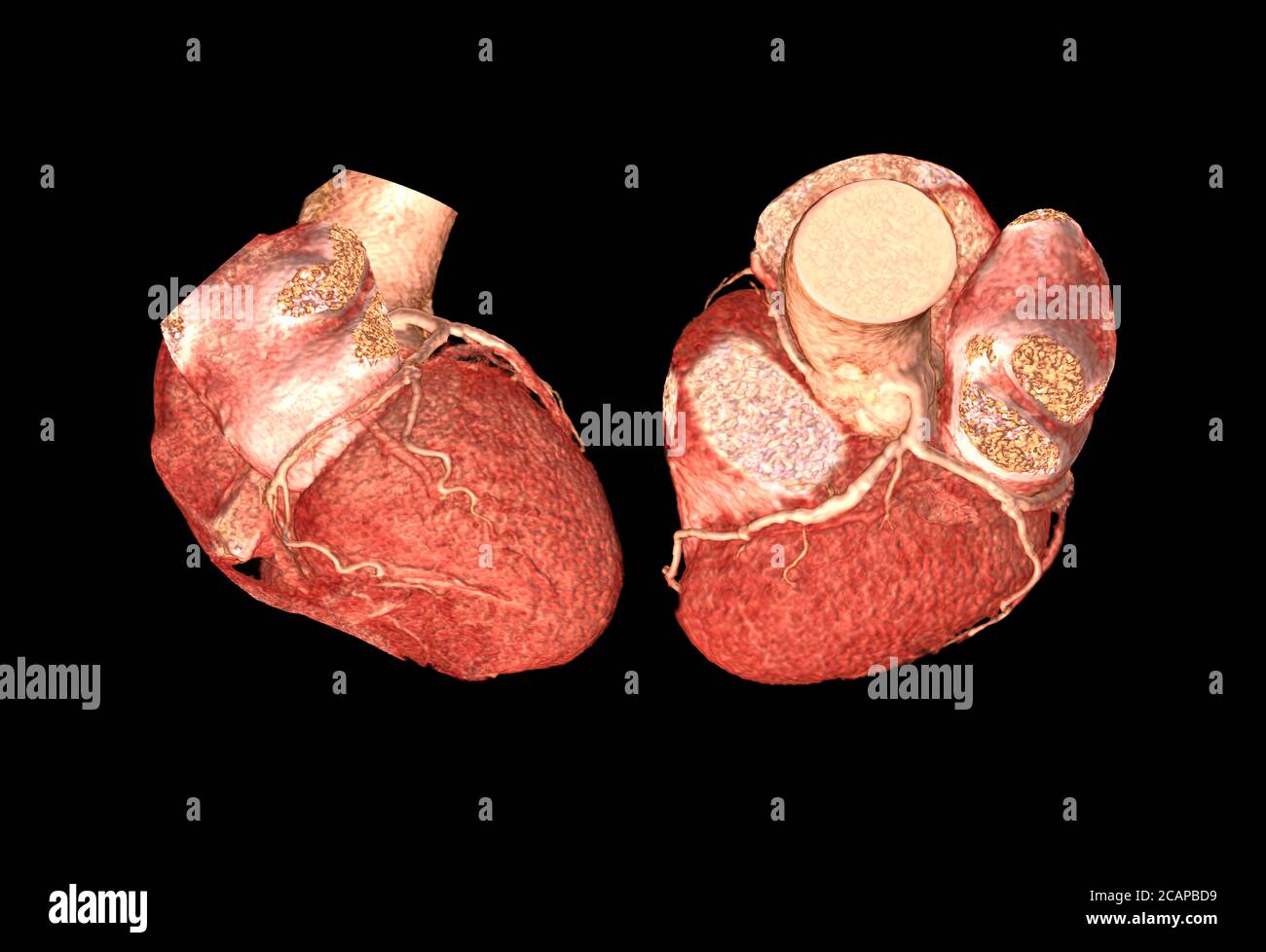 Lateral ad Vista dall'alto dell'arteria coronaria CTA immagine 3D di rendering isolata o backgroud nero per l'individuazione della malattia dell'arteria coronaria. Foto Stock