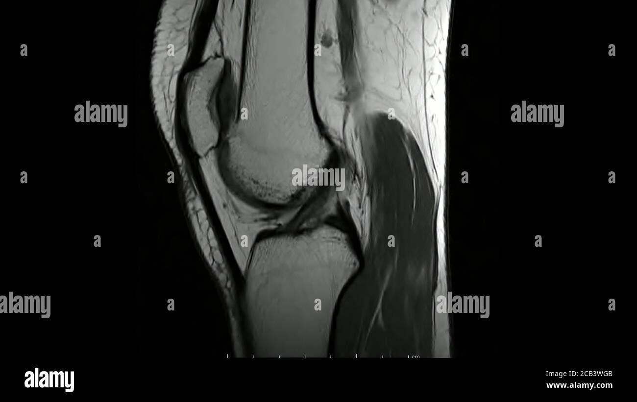 Immagini di risonanza magnetica dell'articolazione del ginocchio T1 sagittale pesata Immagini in modalità cine (articolazione ginocchio RM) mostra l'anatomia del ginocchio Foto Stock