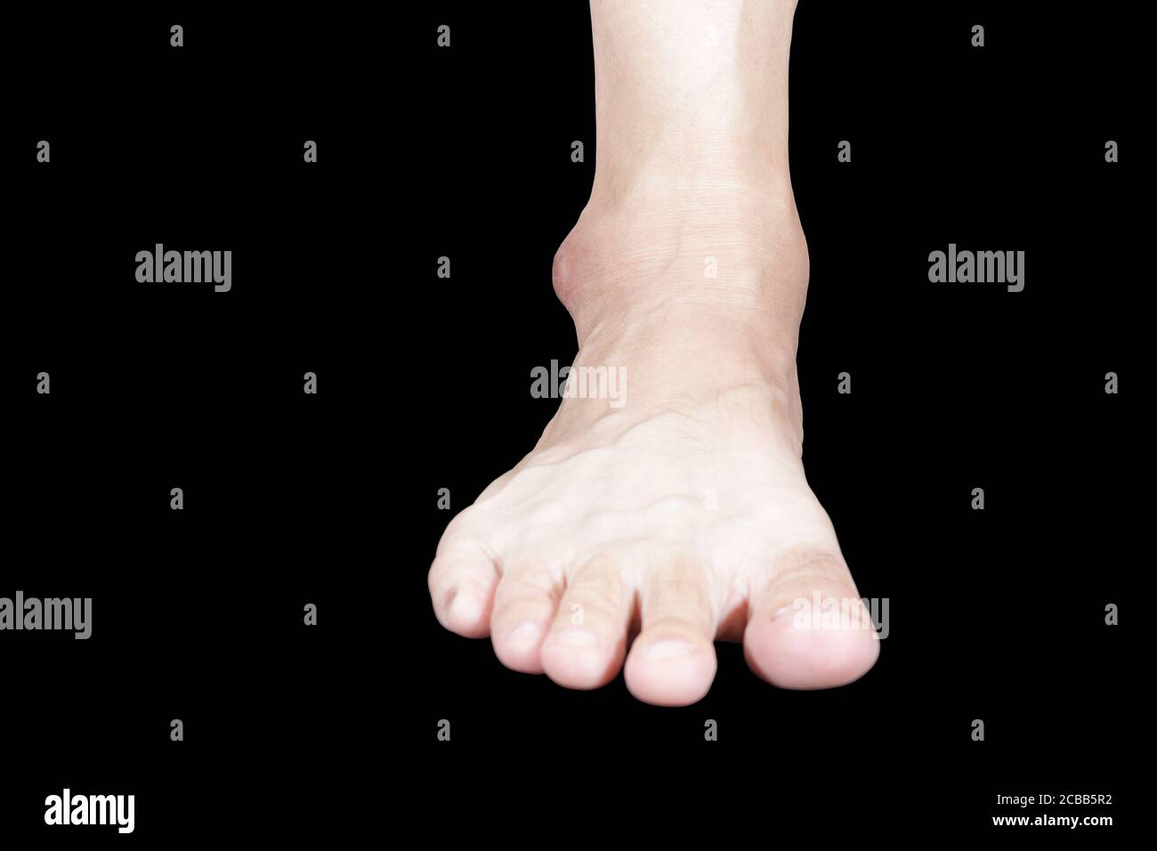 L'immagine del piede destro davanti all'astragalo è gonfia, opaca e nera a  causa di infiammazione Foto stock - Alamy