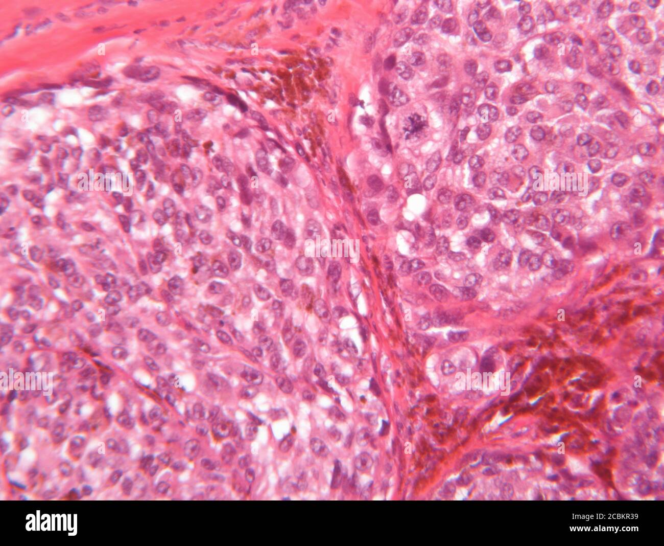 Vista al microscopio del melanoma maligno Foto Stock