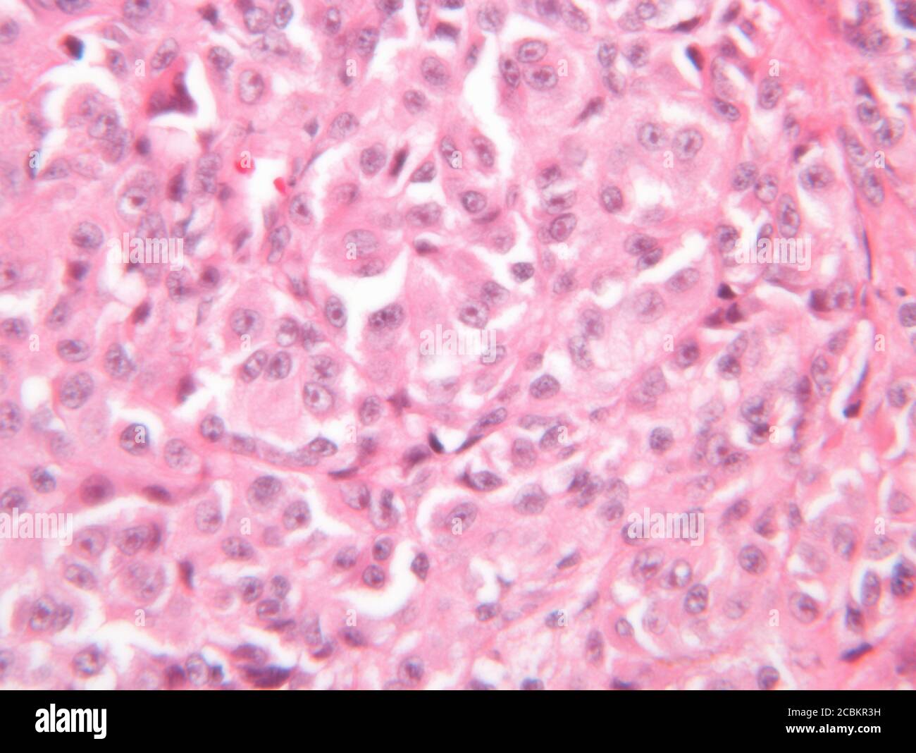Vista al microscopio del melanoma maligno Foto Stock