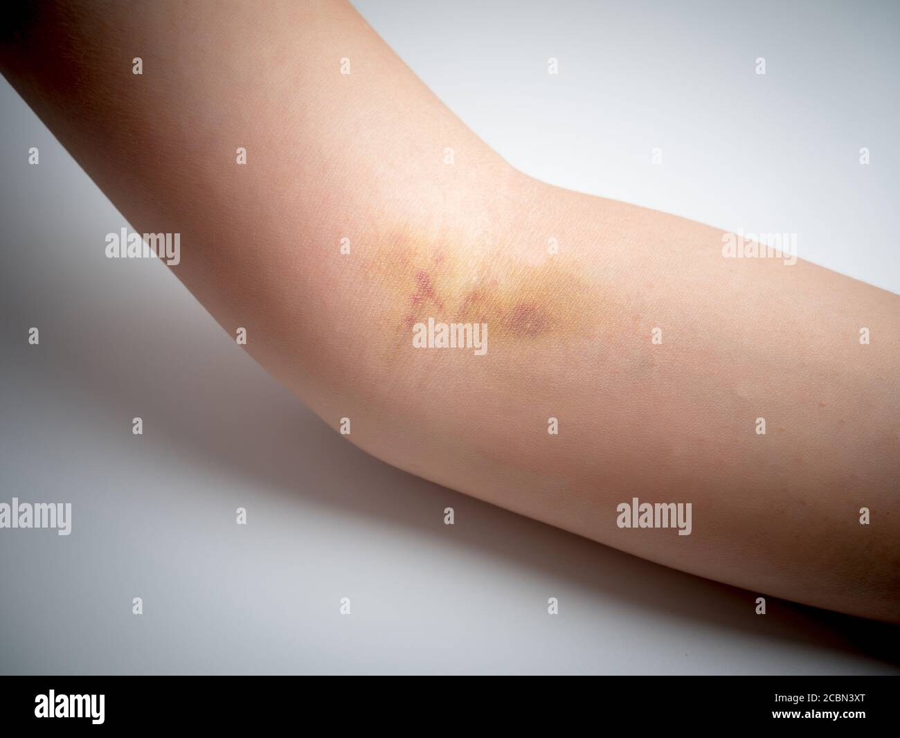 lividi sulla pelle del braccio della donna Foto Stock