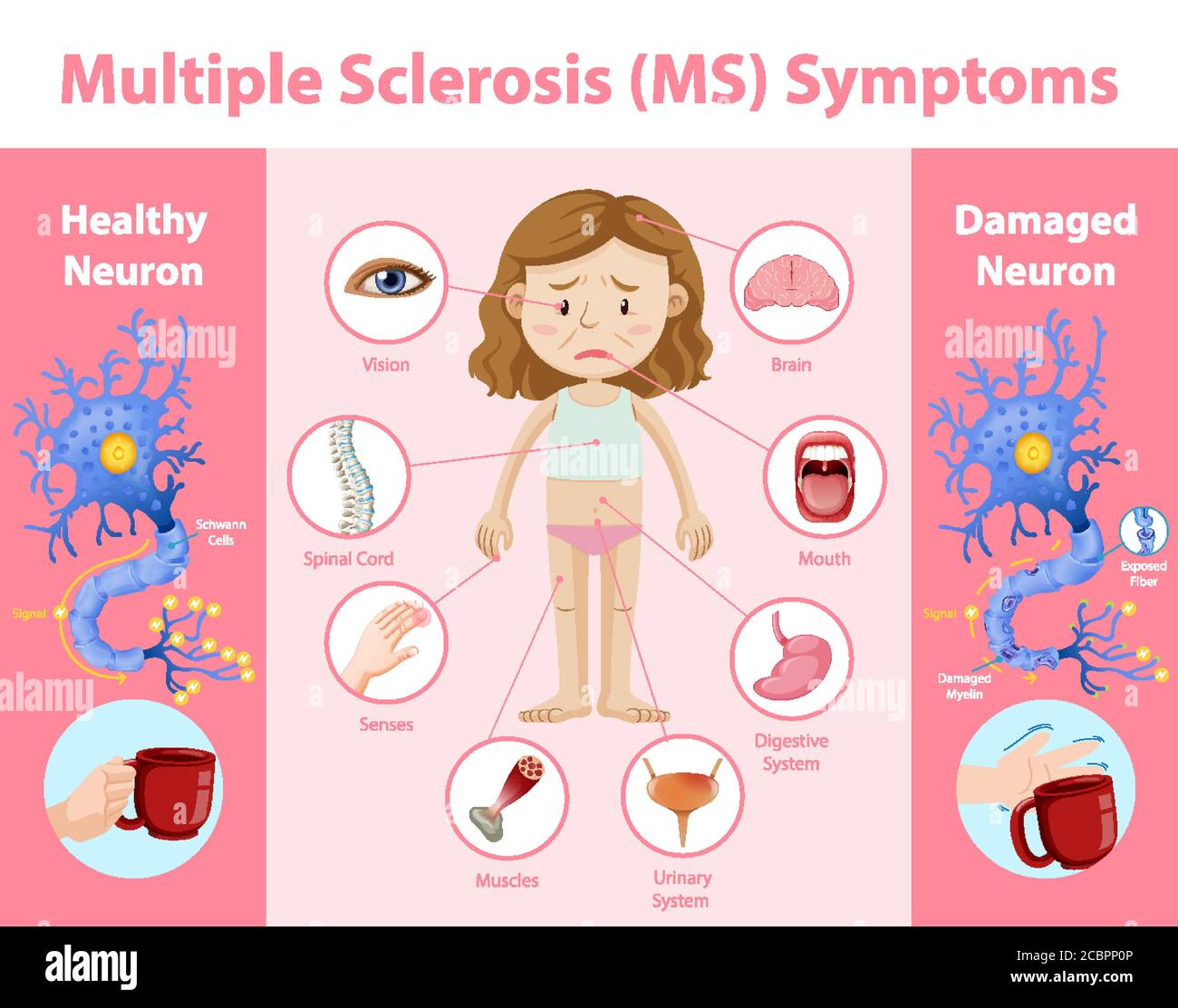 Informazioni sui sintomi della sclerosi multipla (MS) illustrazione infografica Illustrazione Vettoriale