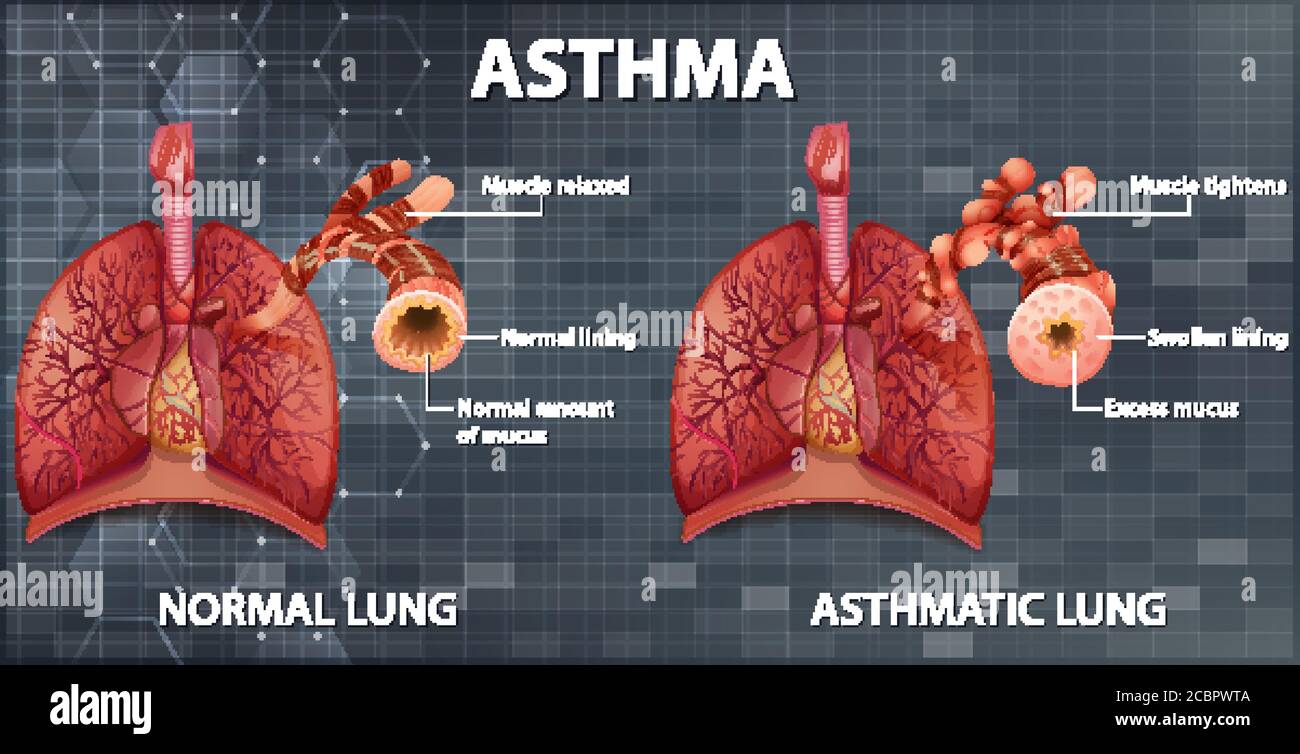 Confronto tra un'illustrazione polmonare sana e un'illustrazione polmonare asmatica Illustrazione Vettoriale