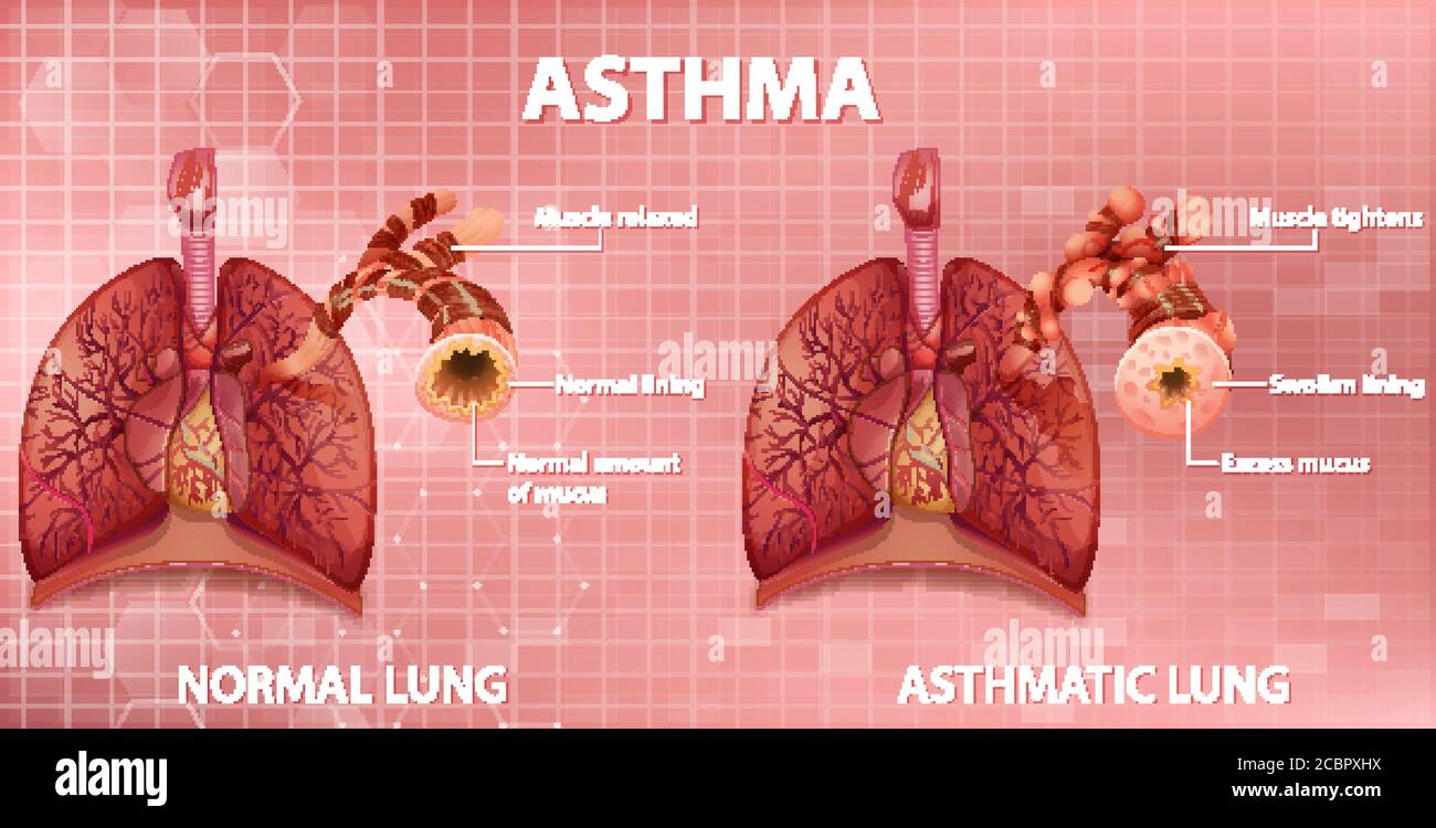 Confronto tra un'illustrazione polmonare sana e un'illustrazione polmonare asmatica Illustrazione Vettoriale
