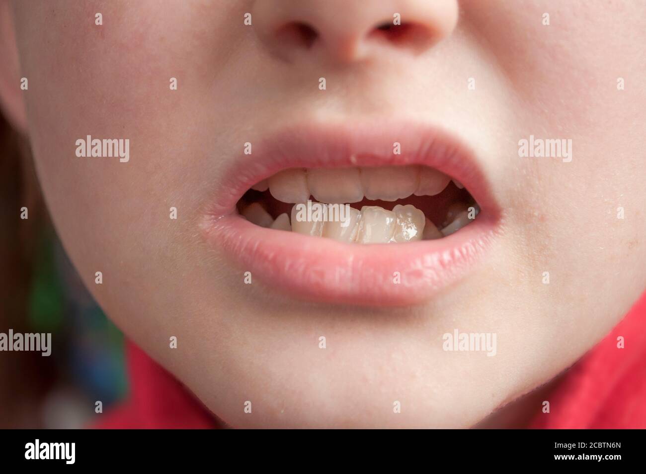 raffigura un bambino sorridente con la sua bocca spalancata, mostrando i suoi denti storti Foto Stock