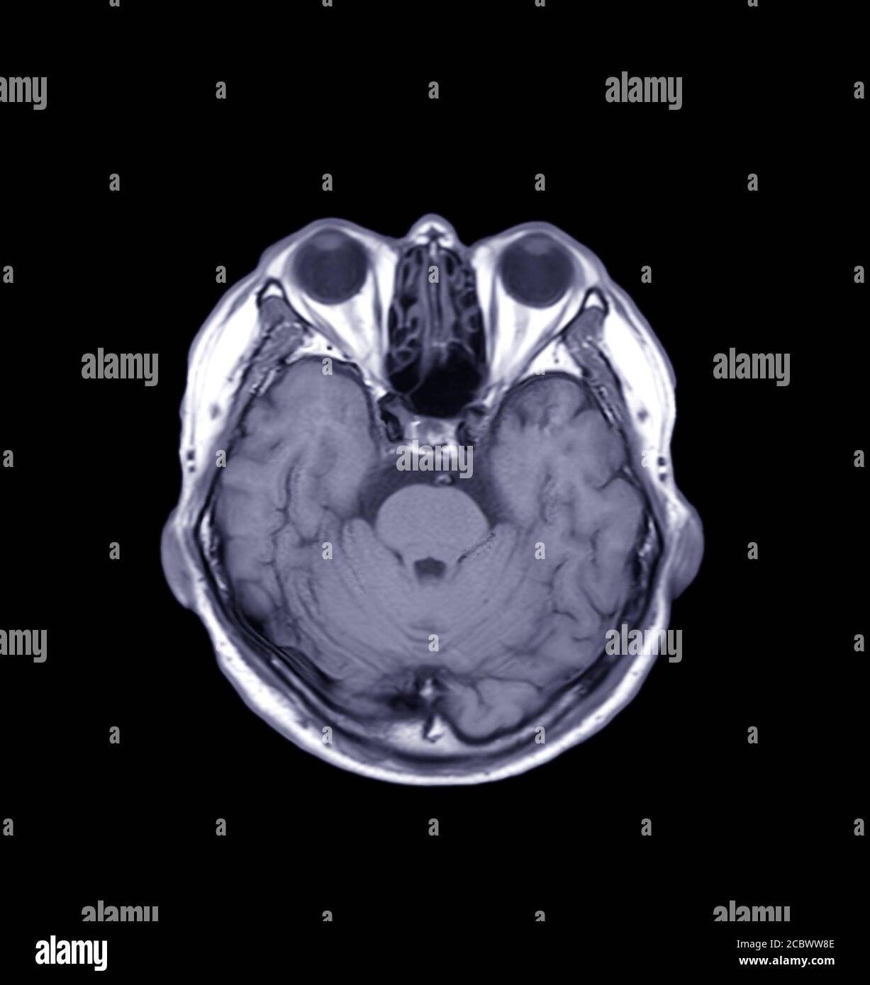 MRI della vista T1 assiale cerebrale per rilevare una varietà di condizioni del cervello come cisti, tumori, sanguinamento isolato su sfondo nero, bleedina Foto Stock