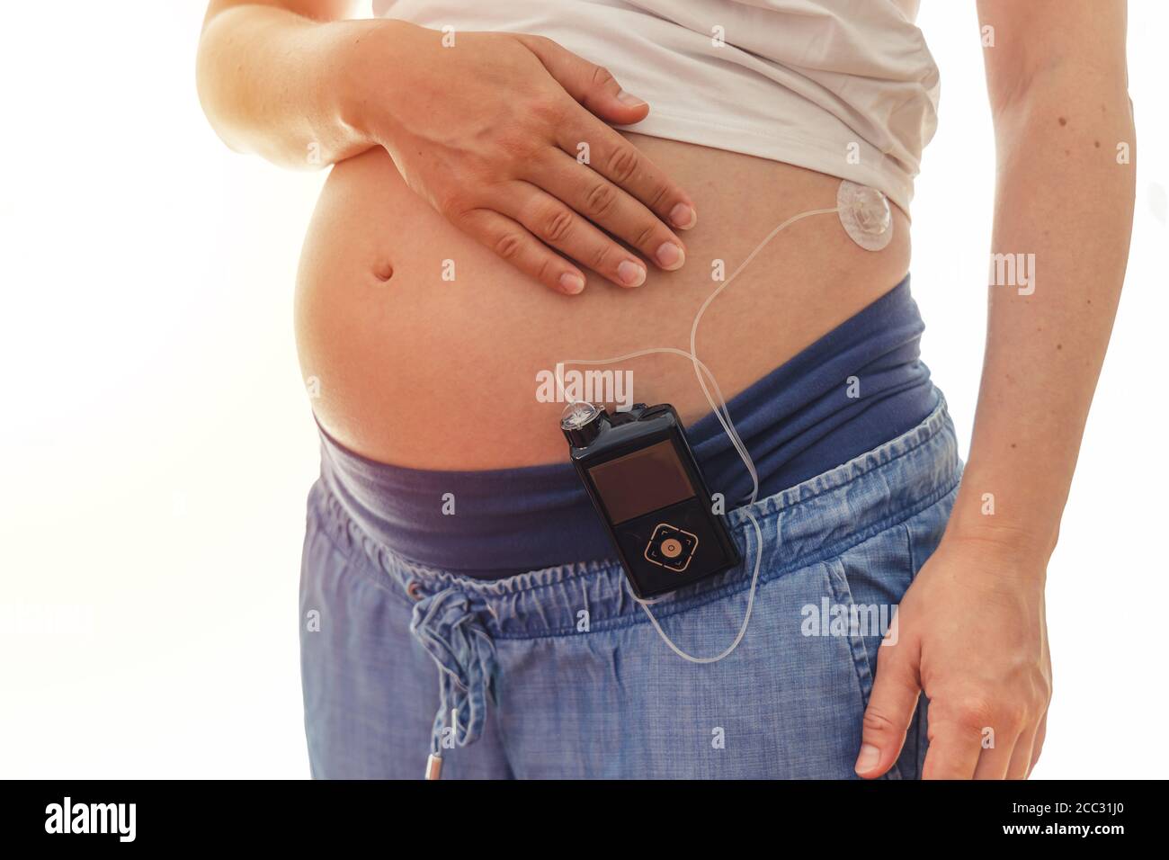 Donna incinta con pompa insulina sui suoi pantaloni e drenaggio montato sul  ventre. Moderno trattamento del diabete Foto stock - Alamy
