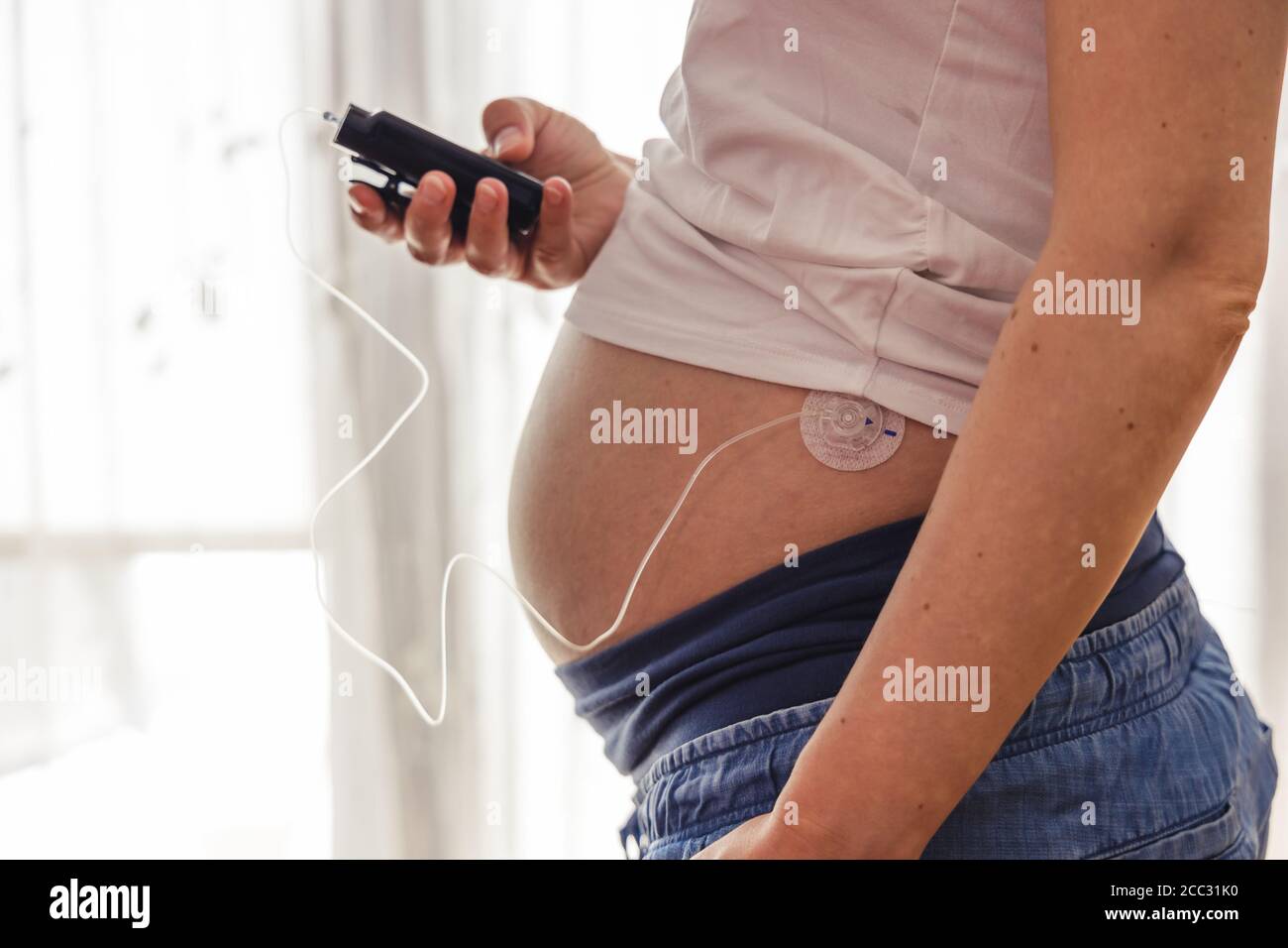 La donna incinta aziona la pompa insulina. Moderno trattamento del diabete attraverso l'insulina data da un drenaggio montato sulla pancia. Foto Stock