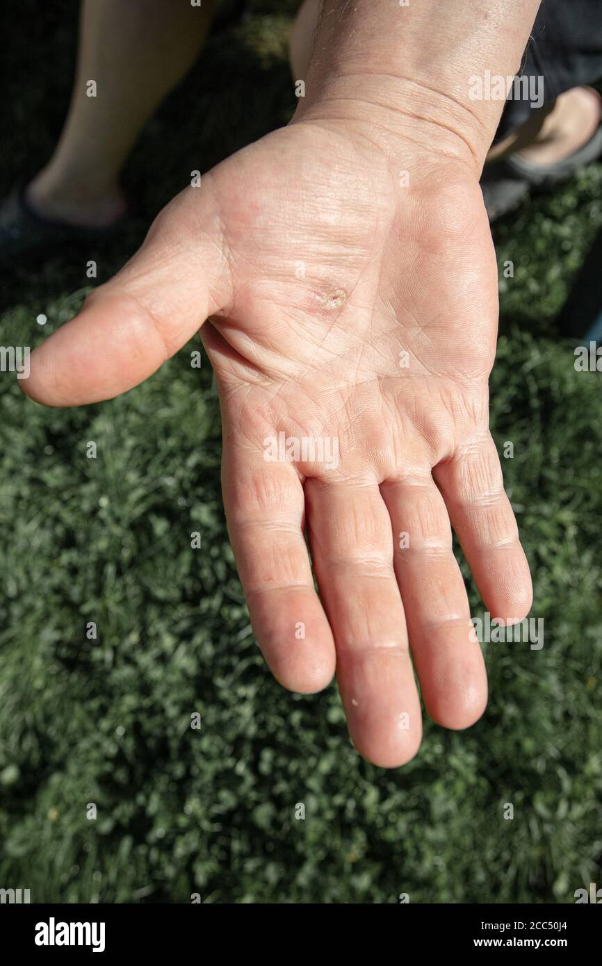 Calluss sulle mani, primo piano delle mani maschili. Foto di alta qualità Foto Stock
