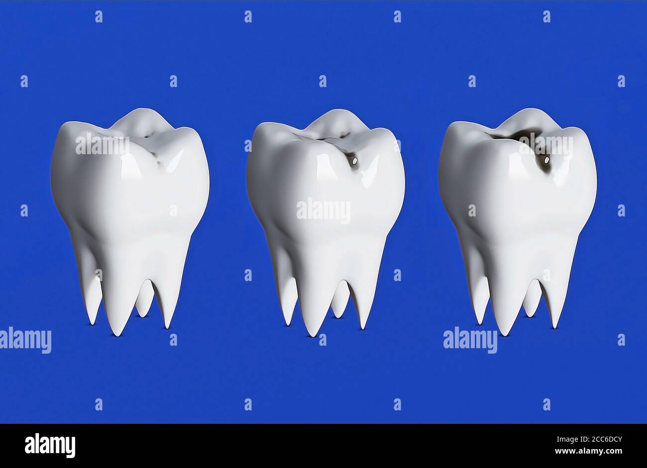 Tre denti in fila, tre stadi di decadimento dei denti, carie, denti  irritati, rendering 3d Foto stock - Alamy