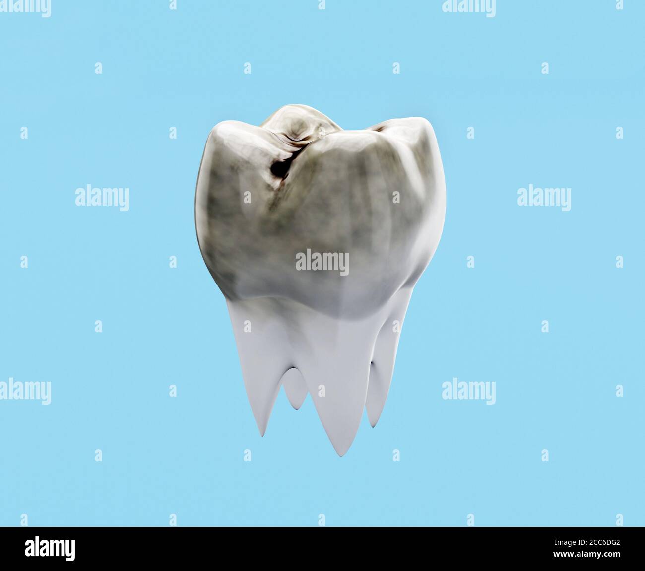 Carioso dente molare su sfondo blu, concetto di decadimento dei denti, carie, rendering 3d Foto Stock