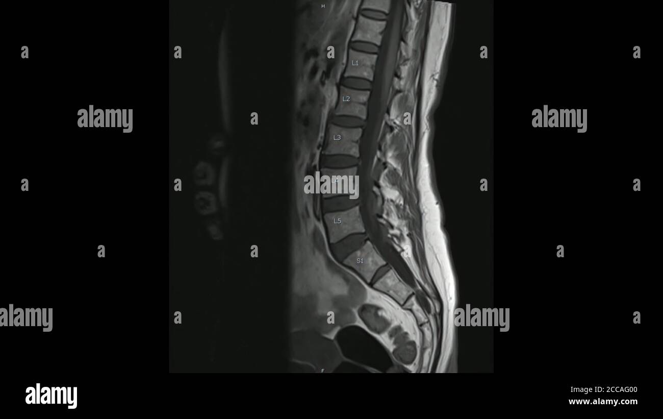 Immagini di risonanza magnetica delle immagini sagittali T1 pesate della colonna lombare (colonna lombare RM) che mostrano una malattia lieve del disco. Foto Stock