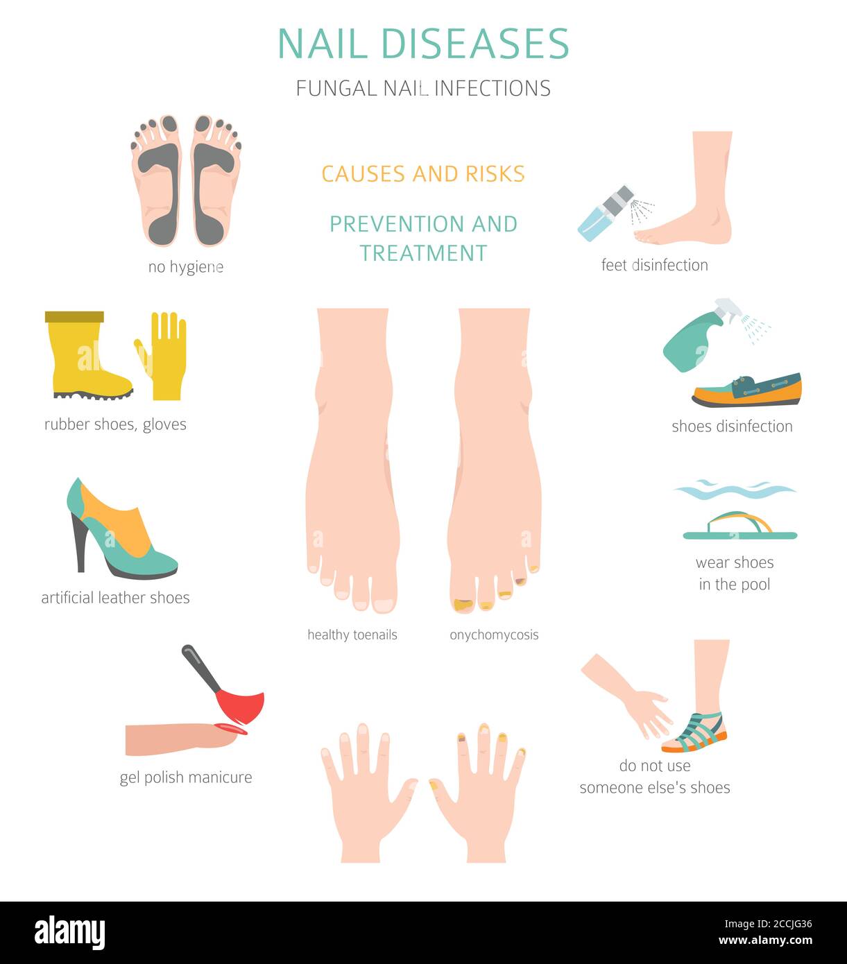 Malattie delle unghie. Onicomicosi, infezioni fungine delle unghie cause, trattamento icona set. Progettazione infografica medica. Illustrazione vettoriale Illustrazione Vettoriale