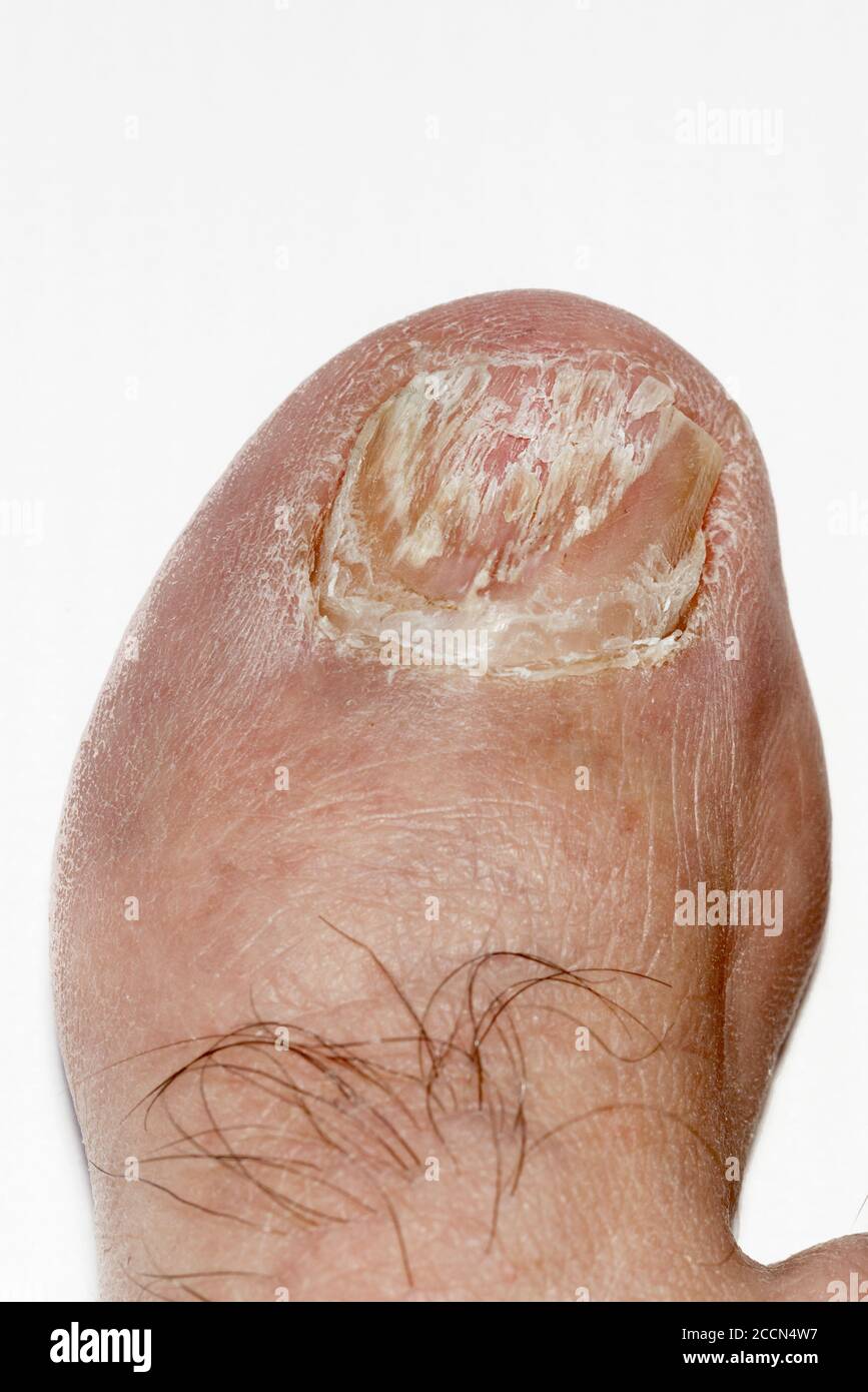 Chiodo a punta grossa con Onychomicosis Foto Stock