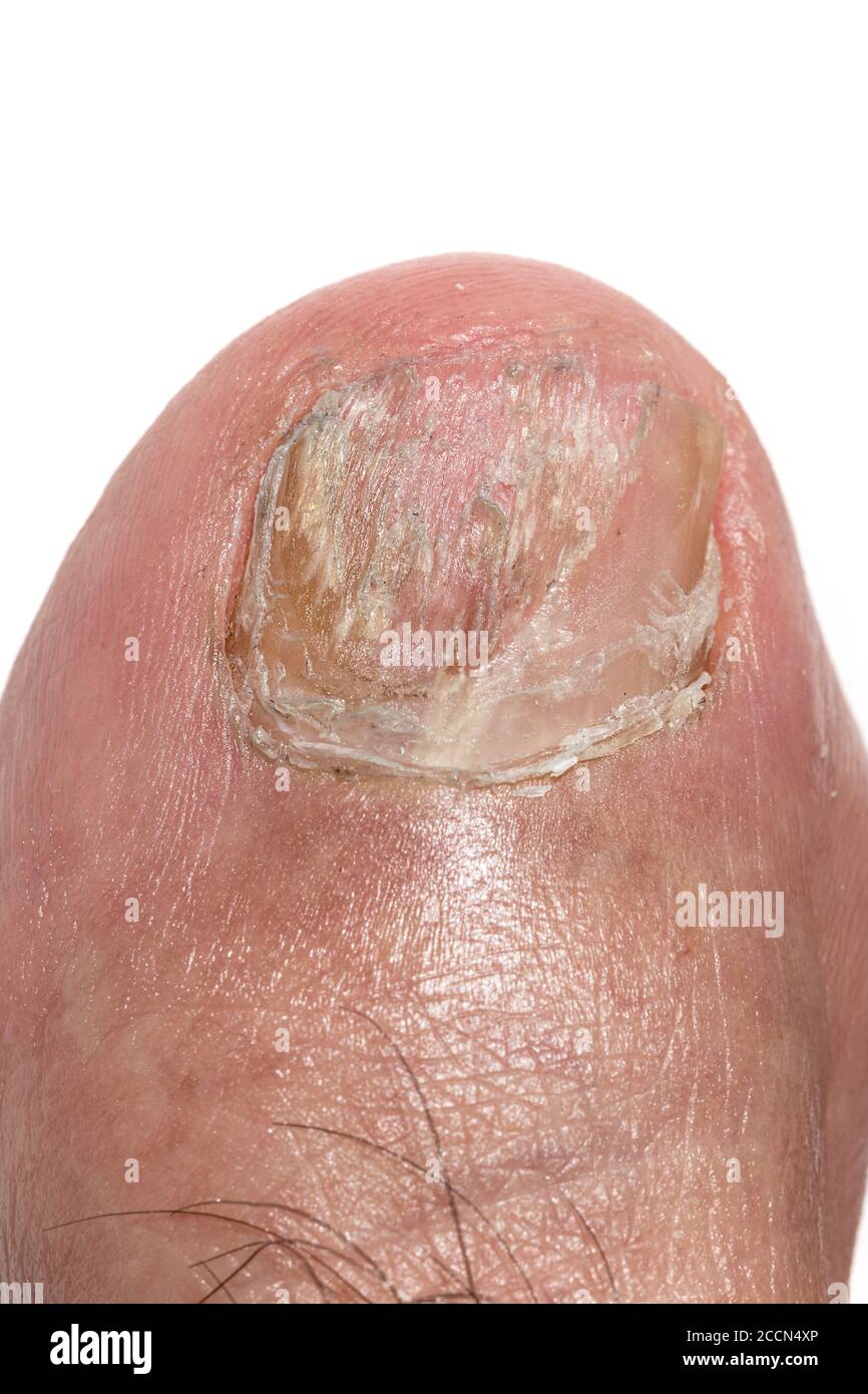 Macro fotografia di un chiodo di punta grande con Onychomicosis Foto Stock