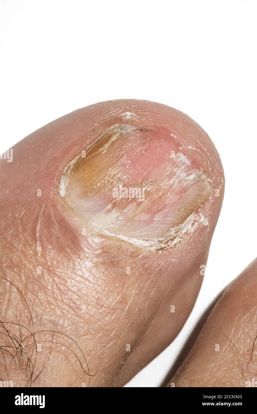 Macro fotografia di un chiodo di punta grande con Onychomicosis Foto Stock