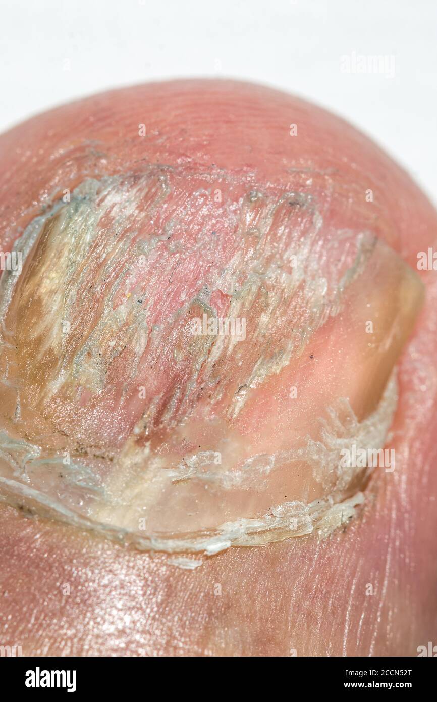 Macro fotografia di un chiodo di punta grande con Onychomicosis Foto Stock
