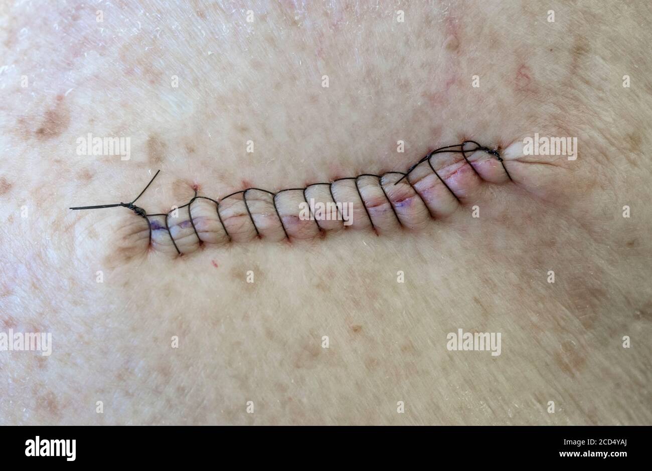 Il cancro della pelle si cucce dopo la chirurgia della Mohs sulla zona della coscia della gamba. I punti sono lunghi 2 pollici. Foto Stock