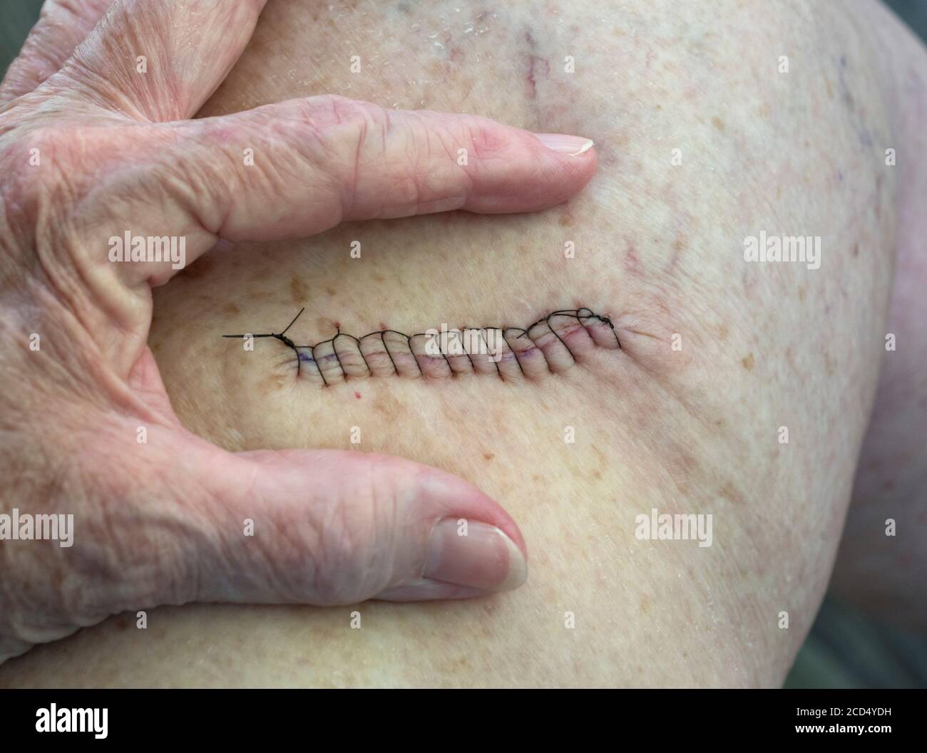 Il cancro della pelle si cucce dopo la chirurgia della Mohs sulla zona della coscia della gamba. I punti sono lunghi 2 pollici. Foto Stock