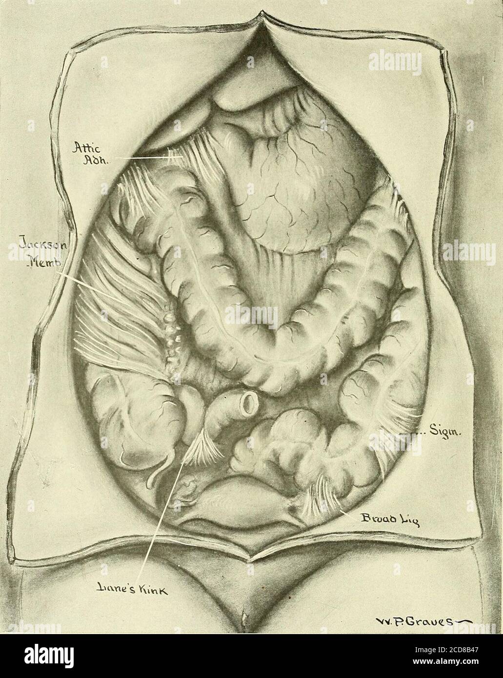 Atlante ed epitome di ginecologia. L epoch e quando la tensione  intra-addomi-nale è aumentata. Sterilità, dalla solita combi-nazione con  ooforite. Febbre (in gonorrea, solo post-sforzo o eccitazione). Prognosi -  la concezione