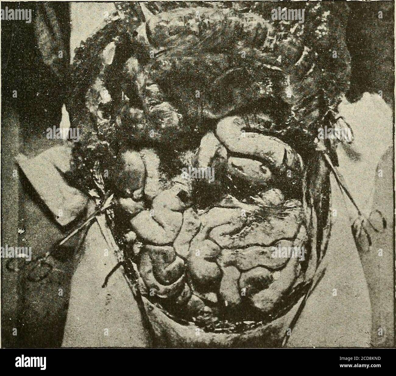 . Terapia medica e chirurgica . Fig. A. – Abdomen ampiamente aperto, gli organi in situ. Tra lo stomaco e il colon trasversale, l'omentum e il mesocolon strettamente Uniti, formano un velo sottile attraverso il quale si intravedono diverse anse dell'intestino situate in alto. Fig. B.-stesso soggetto: Il colon è stato sollevato; si vede la cvirveddeprossione del suo letto attraverso anse dell'intestino tenue; sopra sono tre anse sporgenti dell'intestino tenue. Soggetto wasptosic, con tutte le mesenterie allungate e peduncolate. DIAGNOSI E INDICAZIONI 463 e) la regione lombare dà accesso al kid-ne Foto Stock