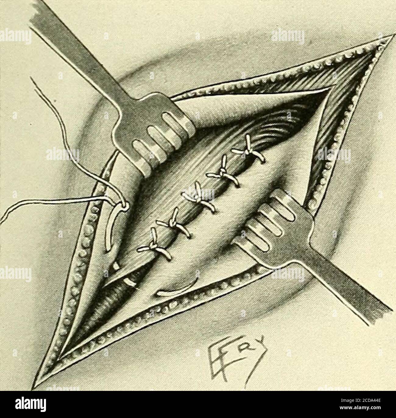 . La chirurgia, i suoi principi e la sua pratica lo ione nell'aponeurosi si chiude successivamente per mezzo di sutura aconduosa del tendine kan-garoo di piccolo calibro, il cordone giacente- di-rettamente sotto questo strato (Fig. 43). Prestare attenzione a lasciare spazio sufficiente all'estremità inferiore o al nuovo anello esterno per consentire al cavo di fuoriuscire senza costrizione indebita. La zona cutanea viene quindi chiusa senza drenaggio,mediante interrottodel catgut fine. Questi suturesare quasi sempre trovato ab-sorbed al momento del primo vestirsi alla fine di una settimana.va detto che Bassinihself usa la seta per Foto Stock