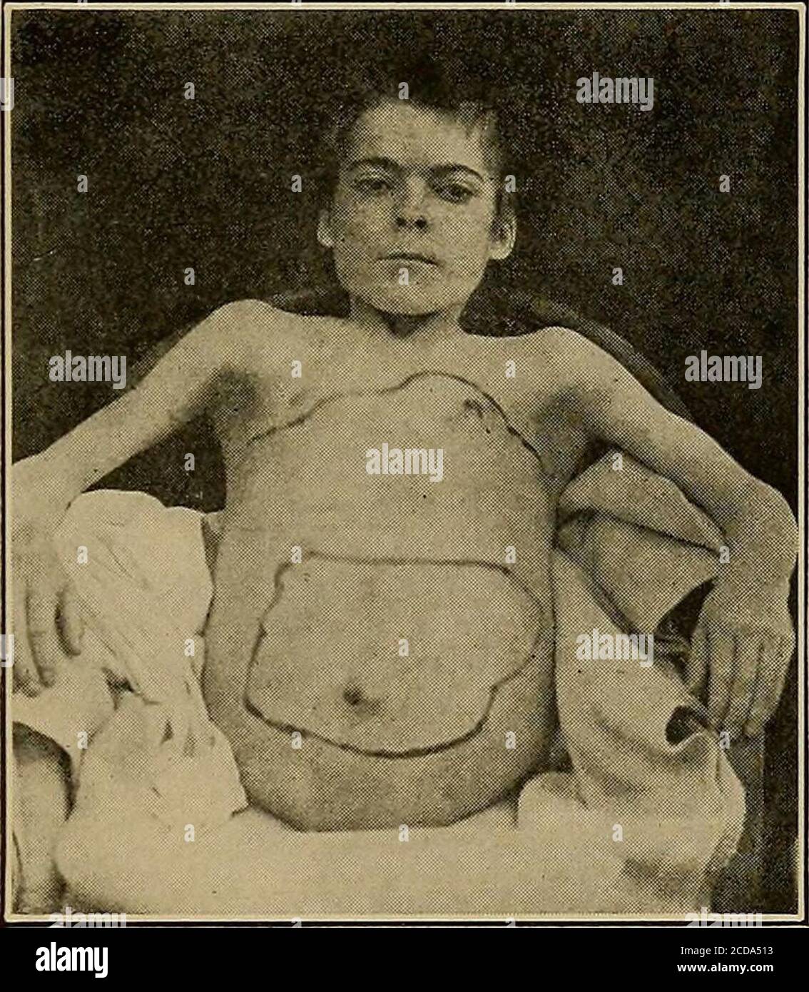 . Diagnosi fisica . Fig. 172.-pericardio aderente, asciti. Evidenza di adesioni mediastiniche o pericardiche, l'effetto di whichis di arrestare completamente i lievi movimenti respiratori di questa parte della parete addominale. (/) il pericardio aderente, che si verifica come parte di un'ampia area di processi fibrosi che coinvolgono la pleura, il mediastino e il theperitoneum, può dare luogo in giovani ad un treno di segni sintomei che suggeriscono cirrosi epatica. Ascite si raccoglie, la livrea si ingrana, ma non ci sono segni nel cuore, reni, o sangue sufficiente a spiegare la condizione. IO Foto Stock